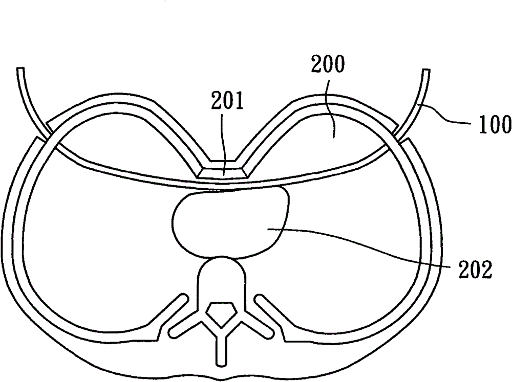 Guide device for correcting pectus excavatum