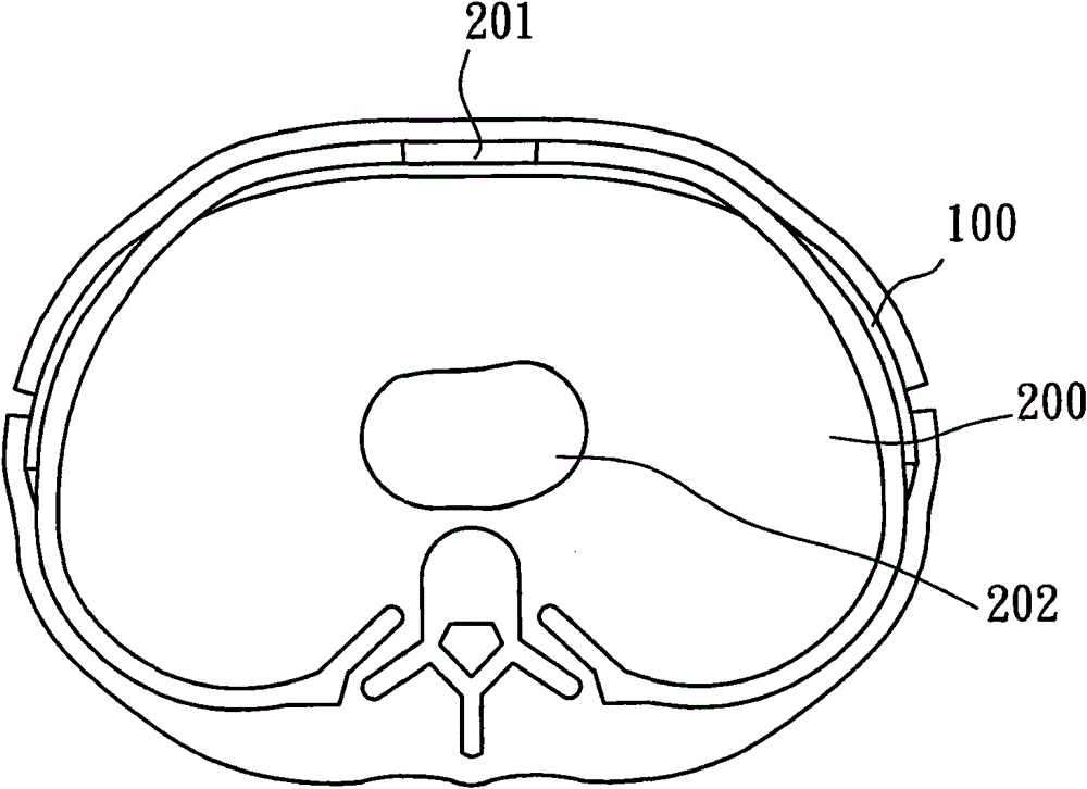 Guide device for correcting pectus excavatum