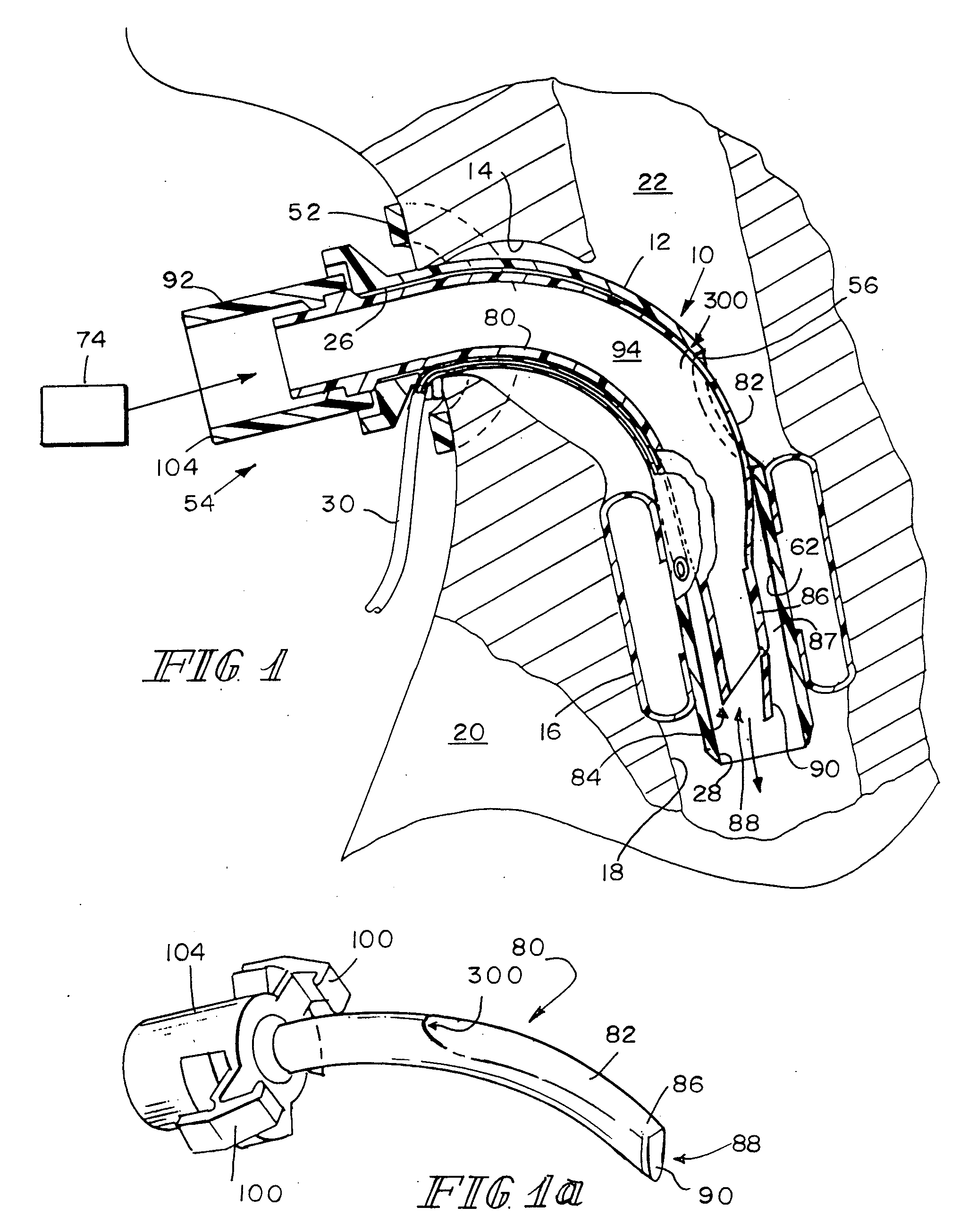 Valved Fenestrated Tracheotomy Tube Having Inner and Outer Cannulae with Pressure Relief