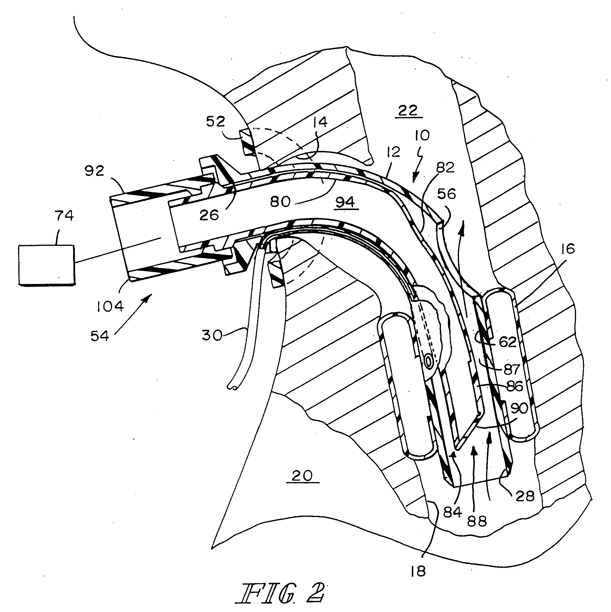 Valved Fenestrated Tracheotomy Tube Having Inner and Outer Cannulae with Pressure Relief