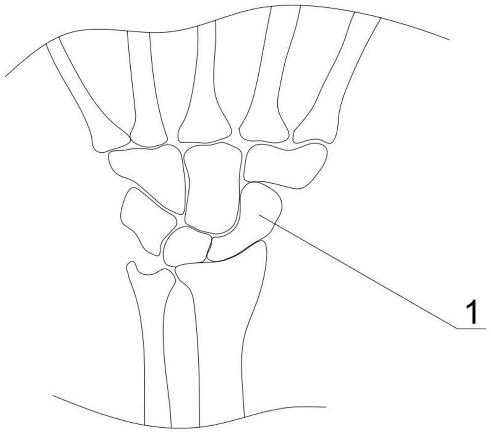 Wrist scaphoid bone replacement prosthesis