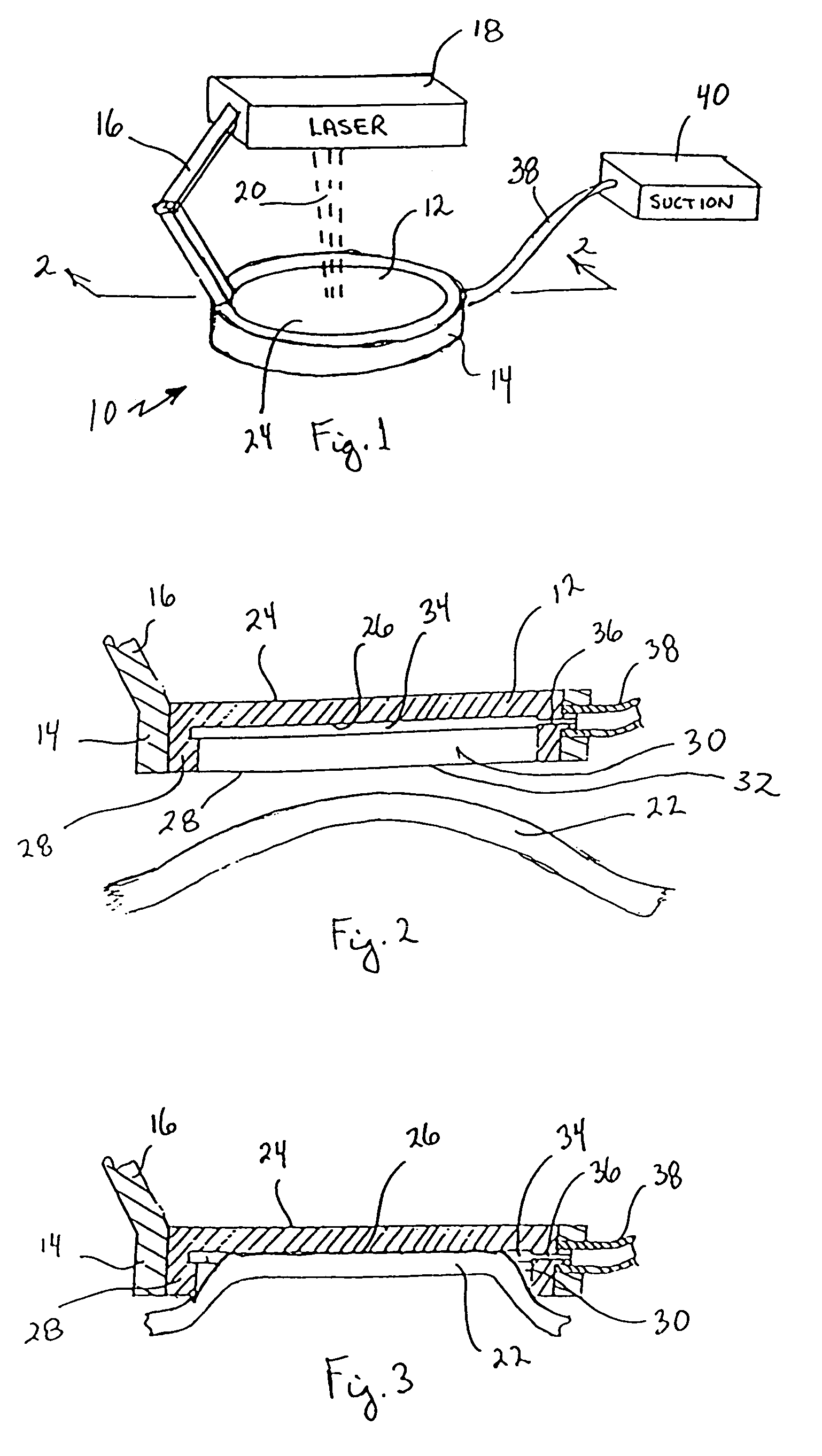 Device and method for reducing corneal induced aberrations during ophthalmic laser surgery