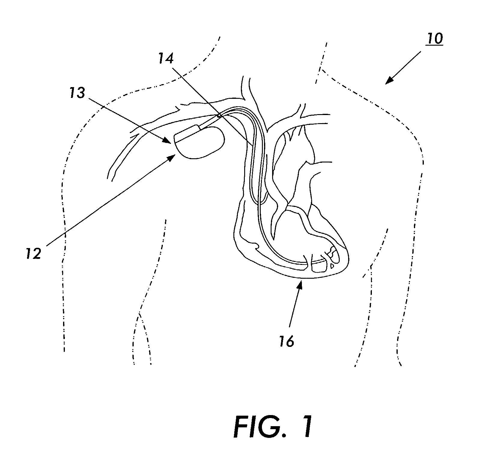 Electromagnetic interference immune tissue invasive system