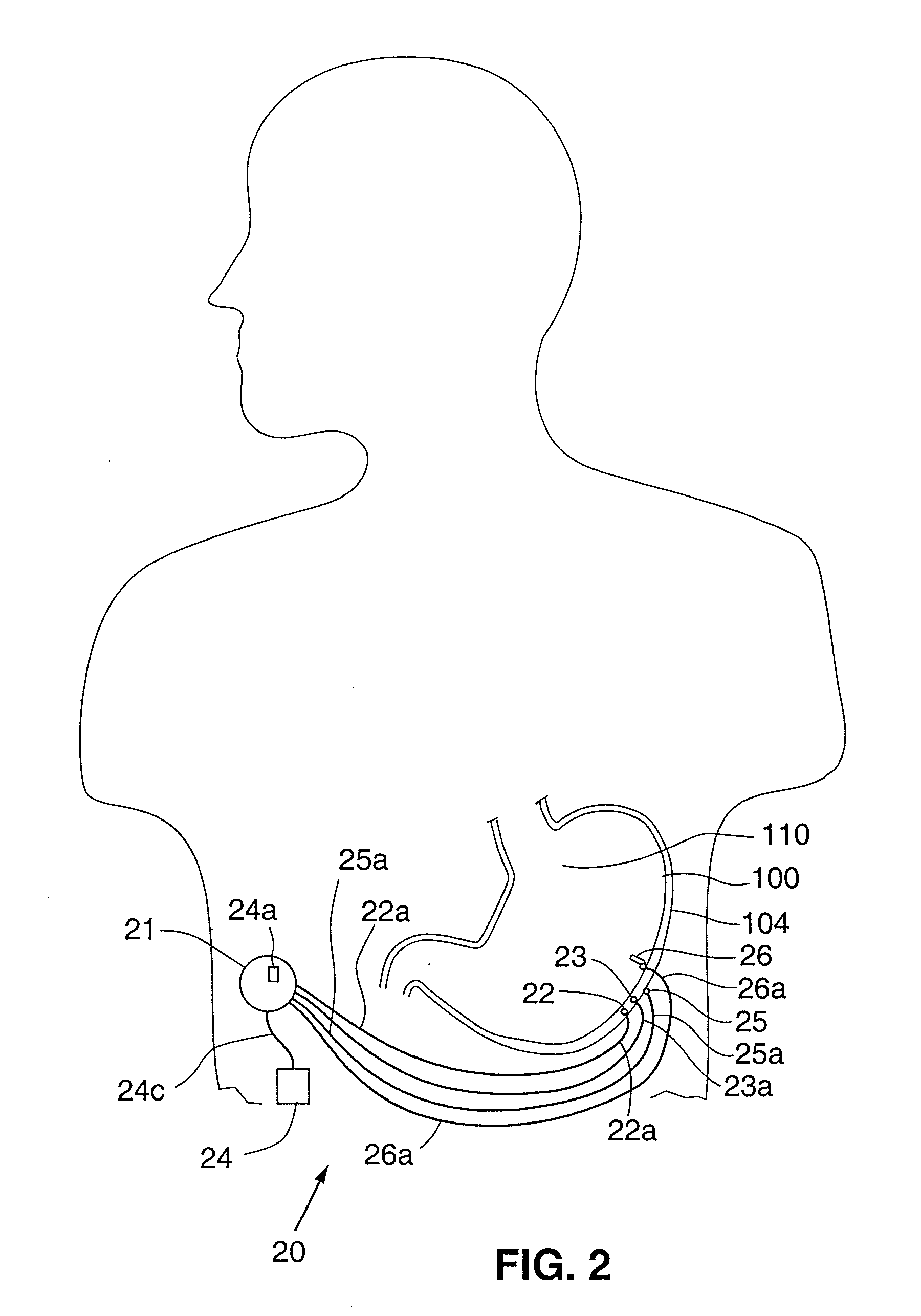 Responsive gastric stimulator