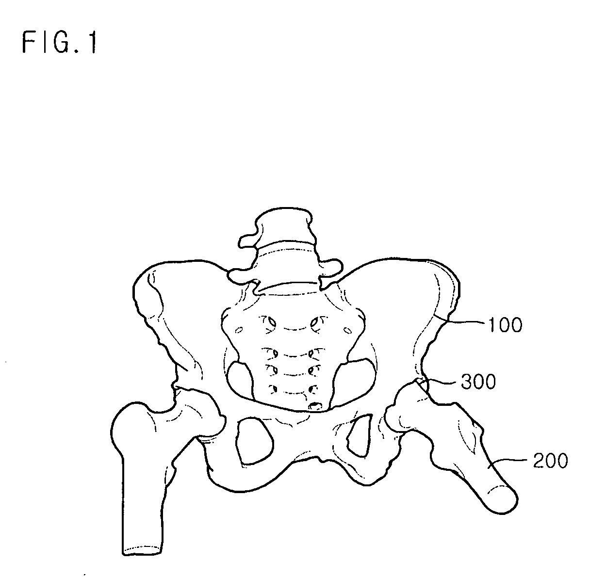 Femoral stem for artificial coxal articulation and method for processing neck portion thereof