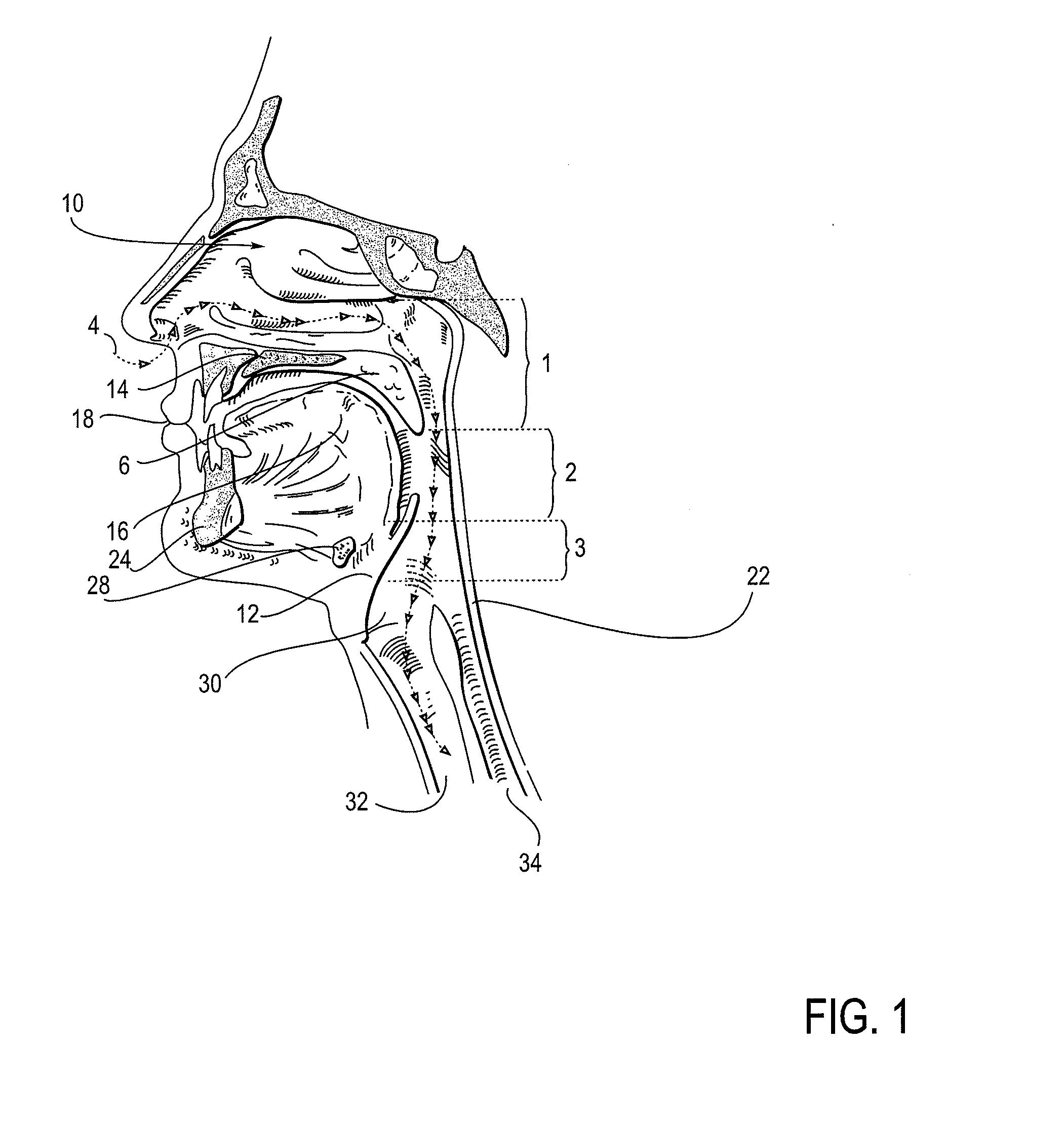 Partially erodable systems for treatment of obstructive sleep apnea