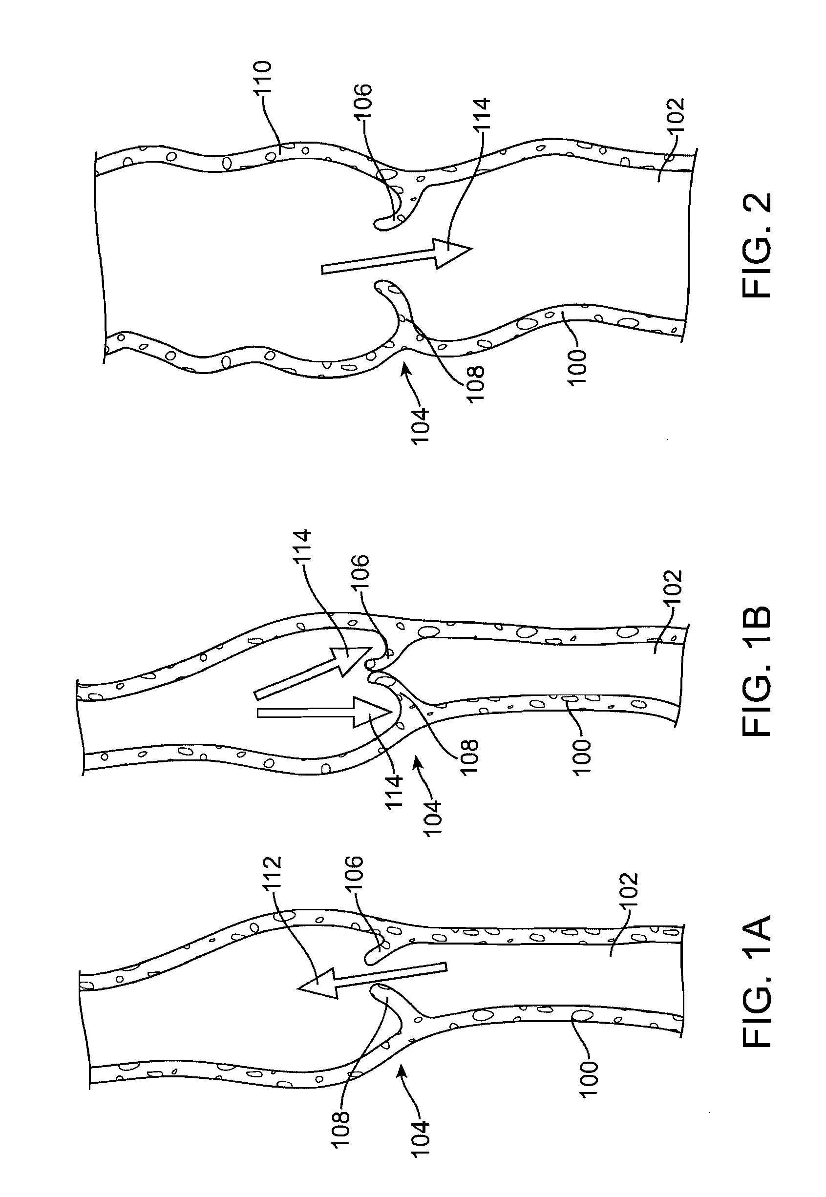 Implantable valve prosthesis for treating venous valve insufficiency