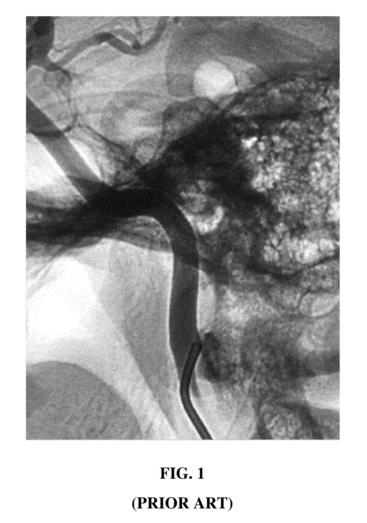 Delivery catheter with fixed guidewire and beveled elliptical port