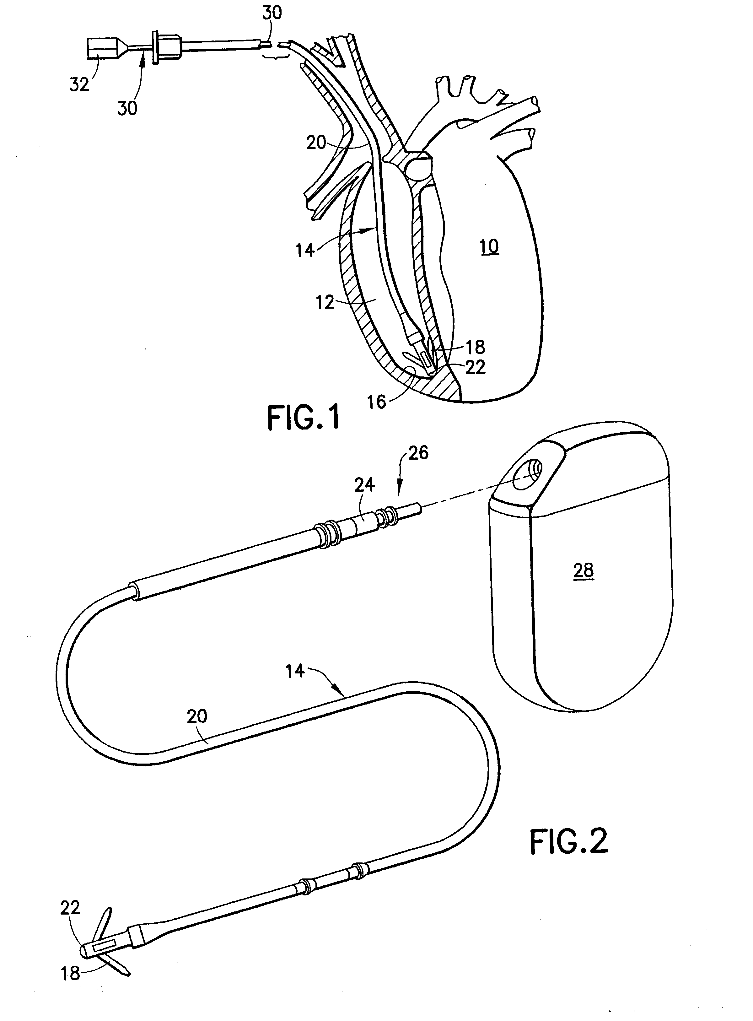 Stylet feature for resisting perforation of an implantable lead