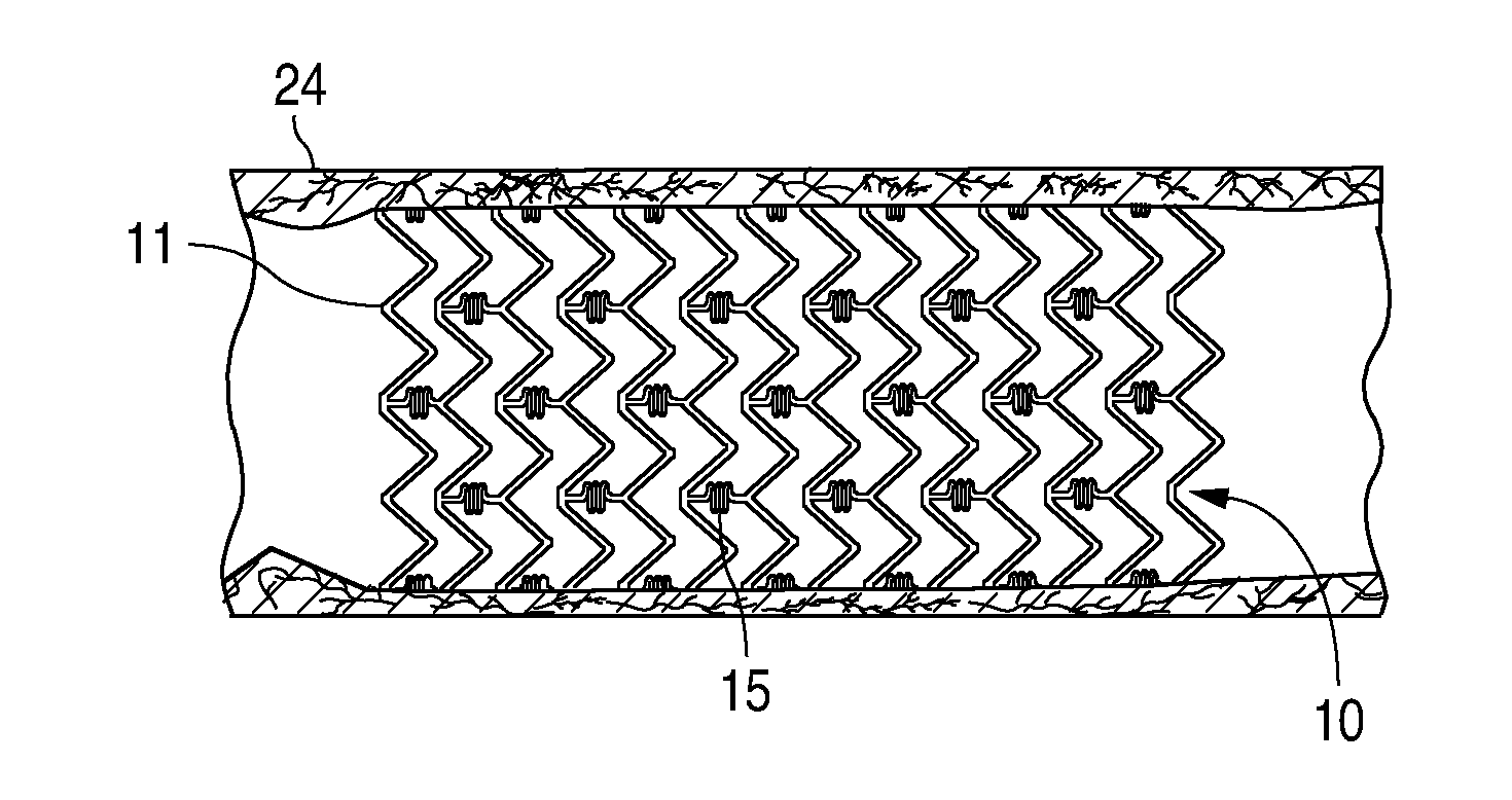 Treatment Of Diabetic Patients With A Stent And An Adjunctive Drug Formulation