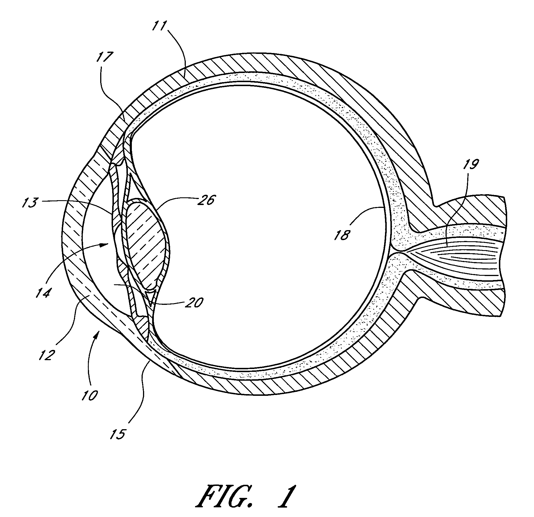 Implant with intraocular pressure sensor for glaucoma treatment