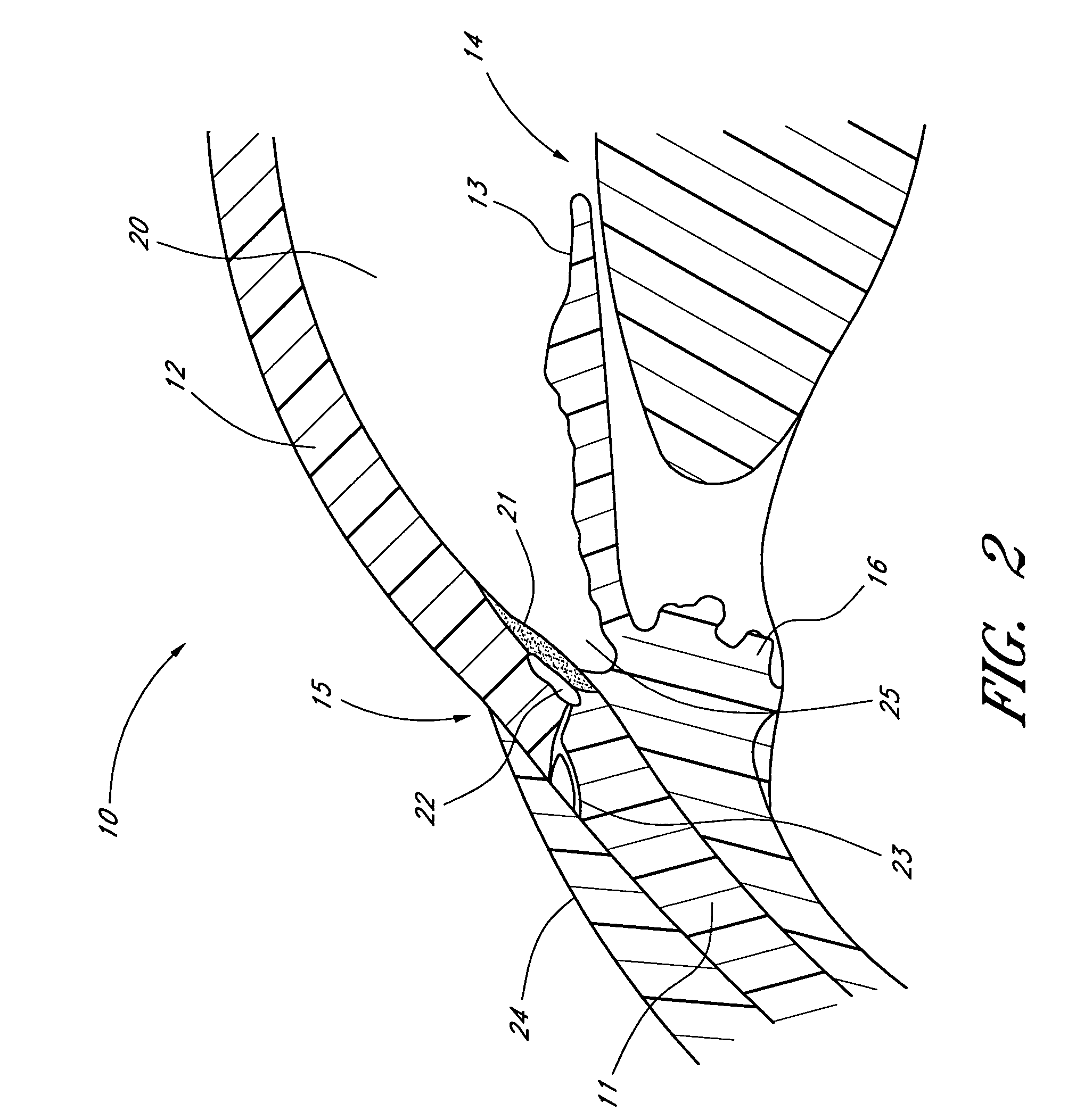 Implant with intraocular pressure sensor for glaucoma treatment