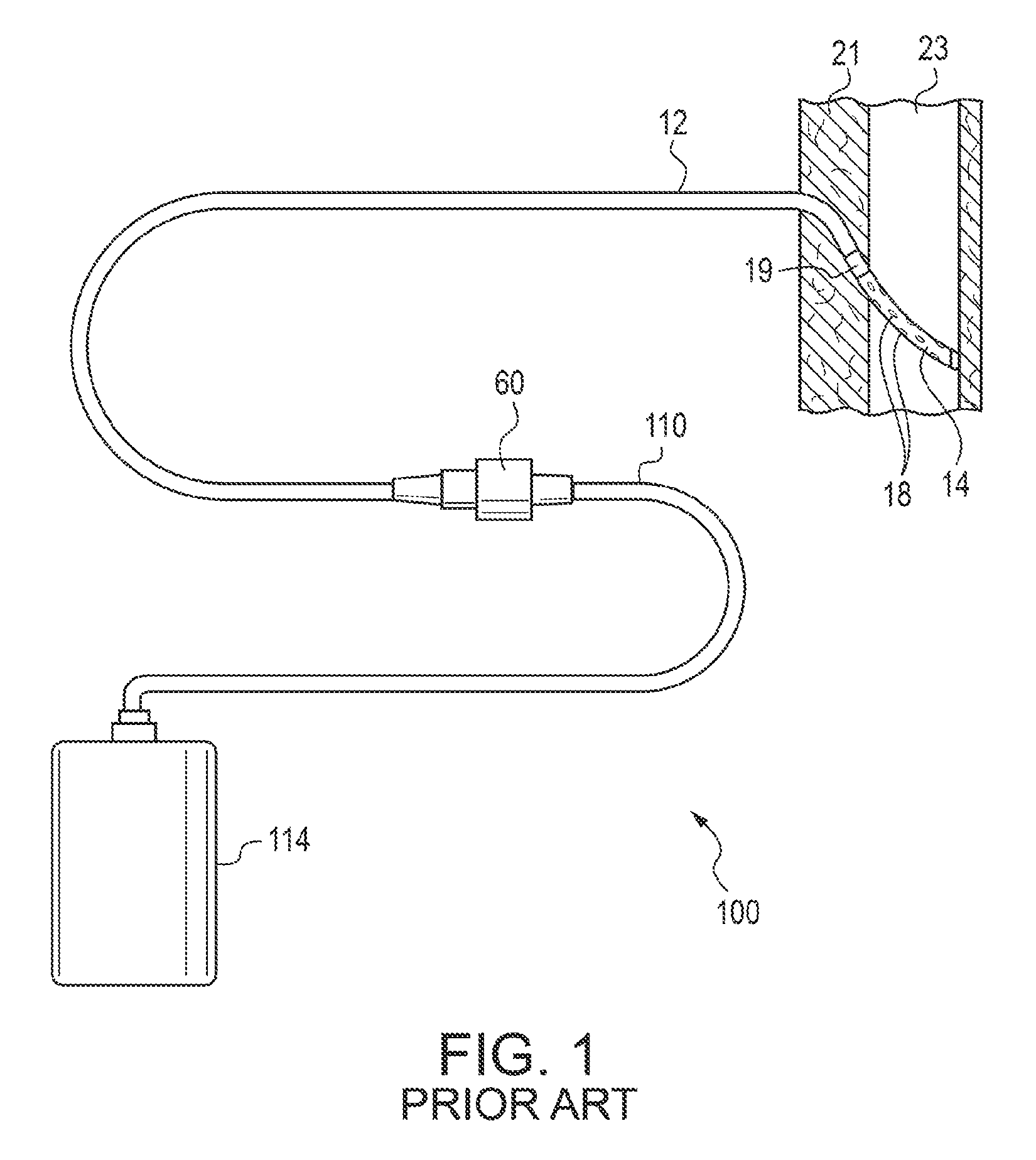 Active pleurodesis catheter