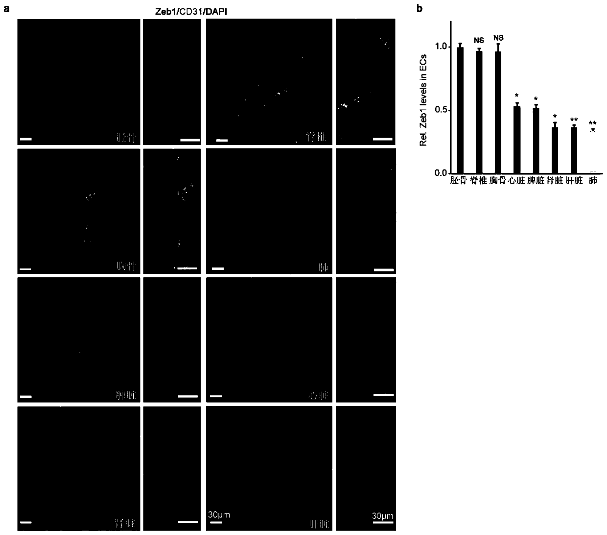 Purpose and relevant medicine of ZEB1 (Zinc Finger E-Box-Binding Protein 1) gene