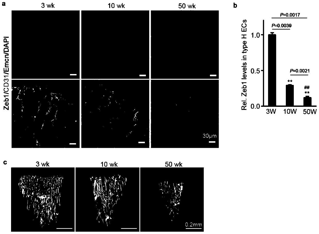 Purpose and relevant medicine of ZEB1 (Zinc Finger E-Box-Binding Protein 1) gene