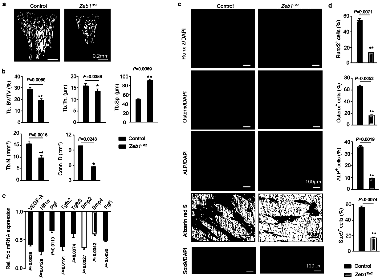 Purpose and relevant medicine of ZEB1 (Zinc Finger E-Box-Binding Protein 1) gene