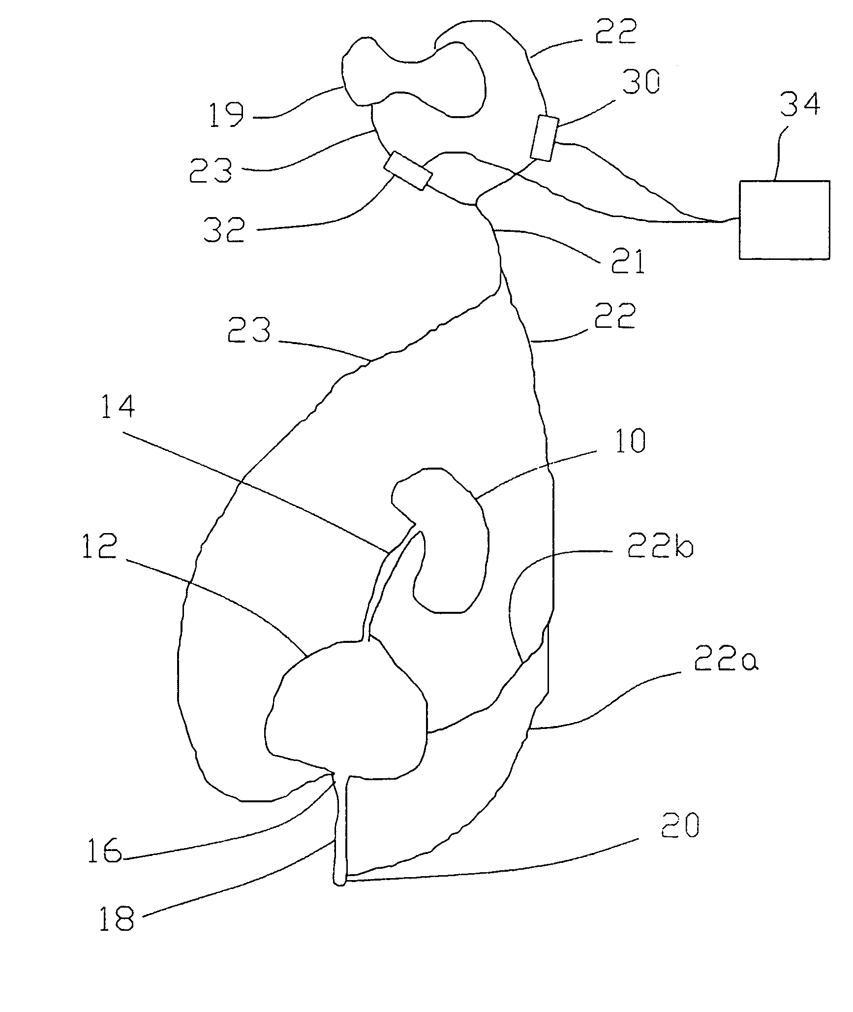 Combined stimulation of ventral and dorsal sacral roots for control of bladder function