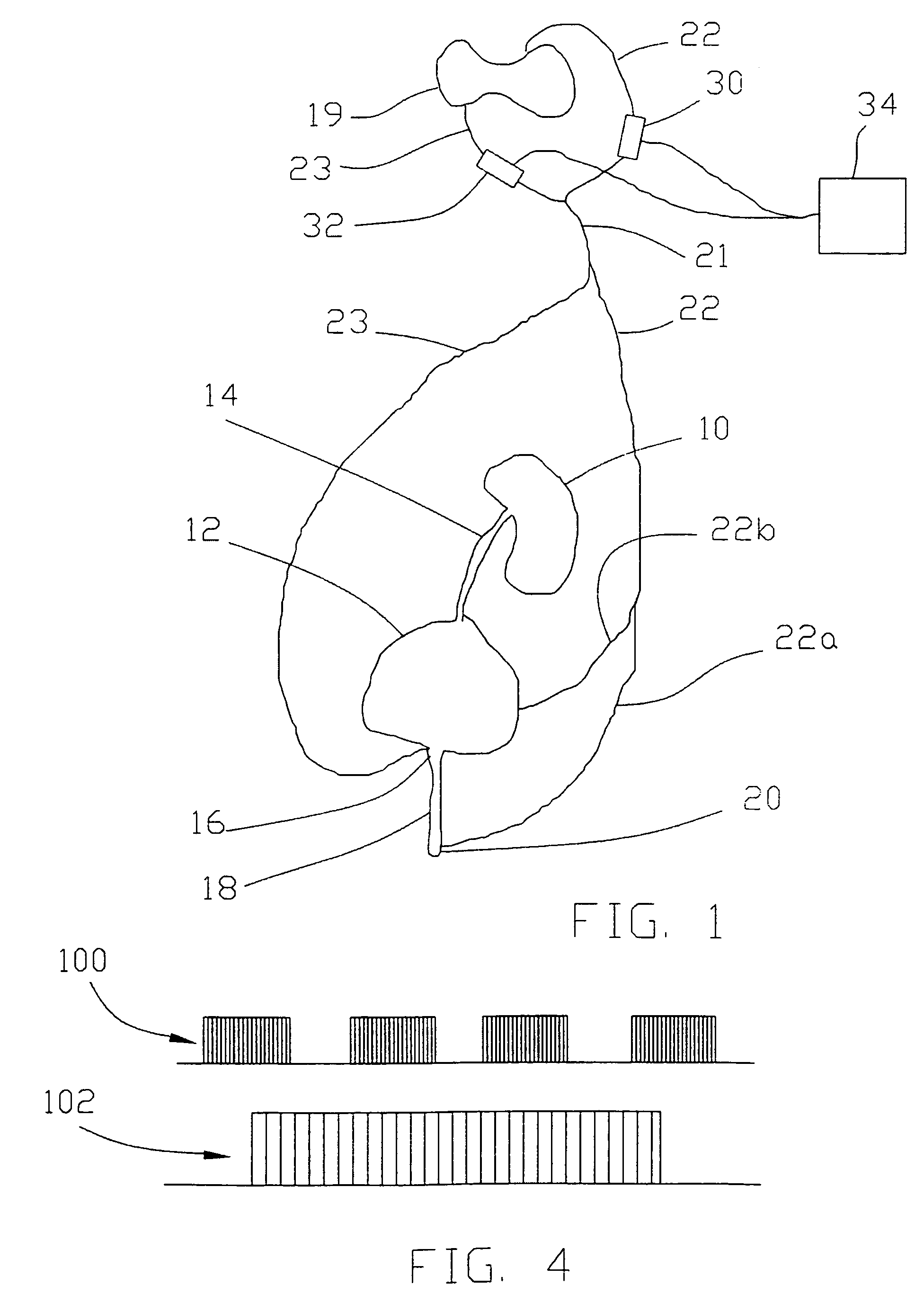 Combined stimulation of ventral and dorsal sacral roots for control of bladder function