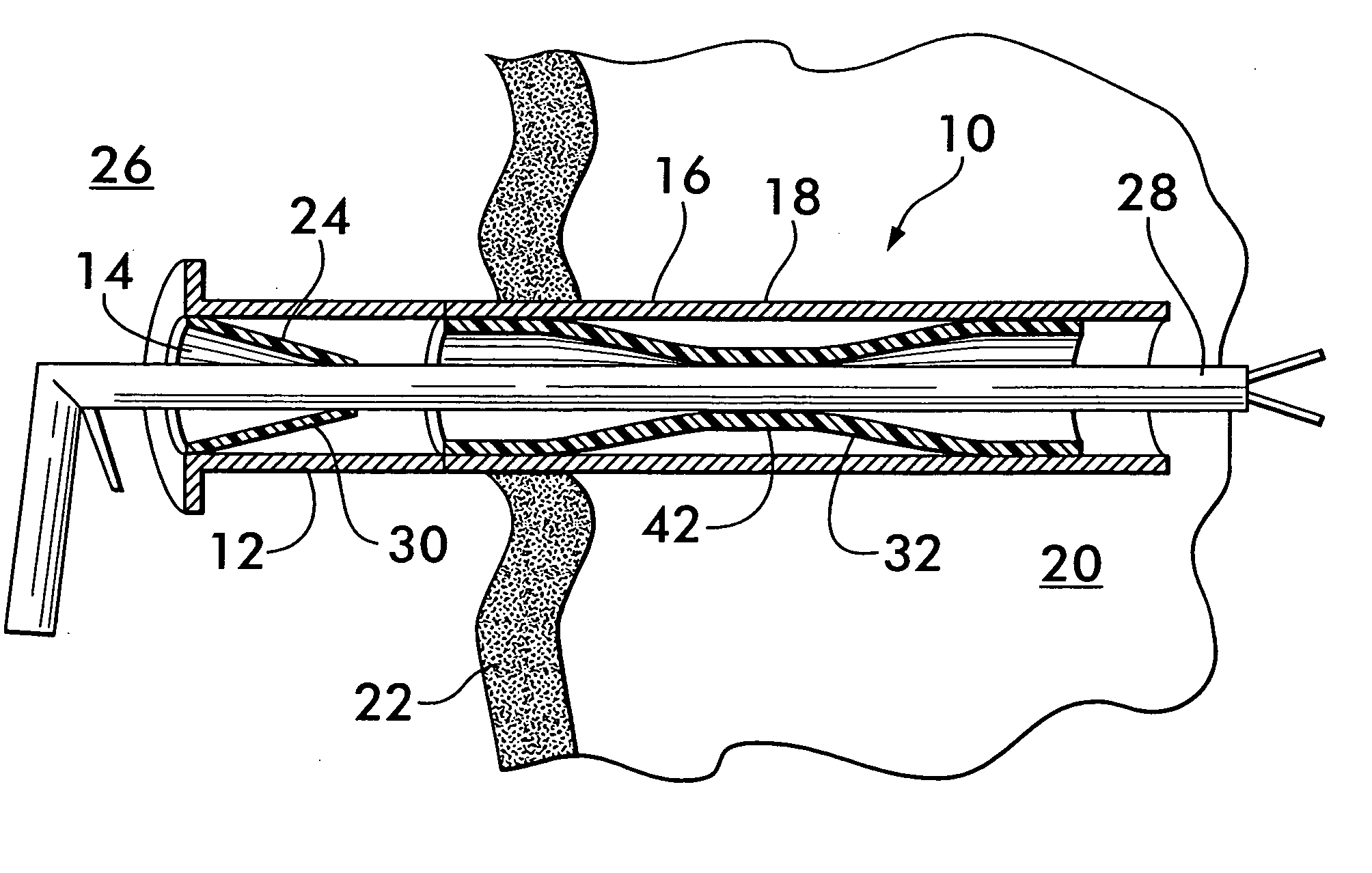 Access port for laparoscopic surgery