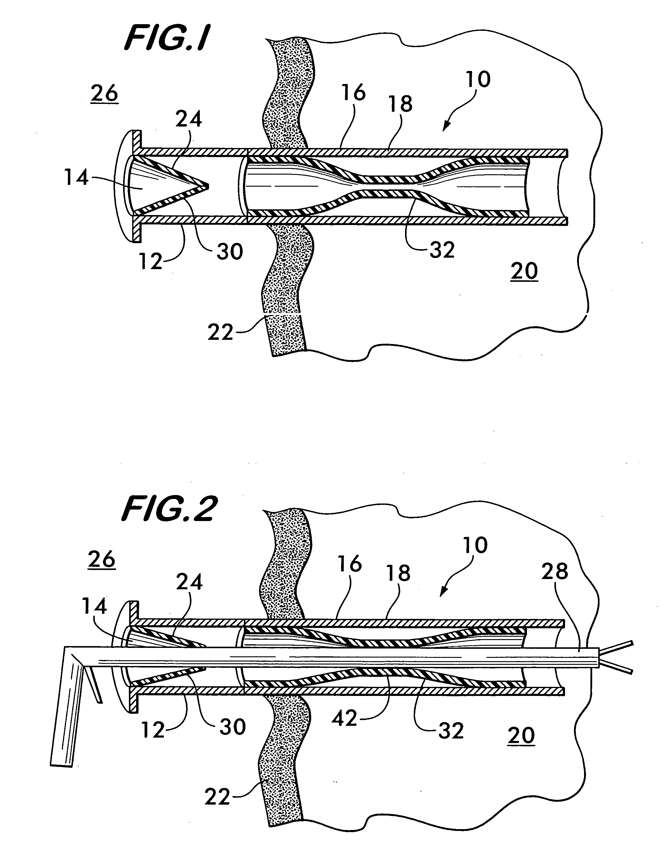 Access port for laparoscopic surgery