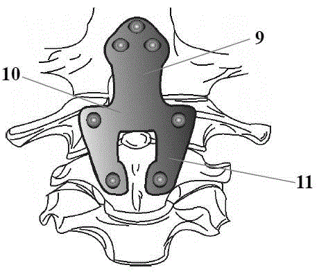 Anterior cervical and craniocervical fixing device