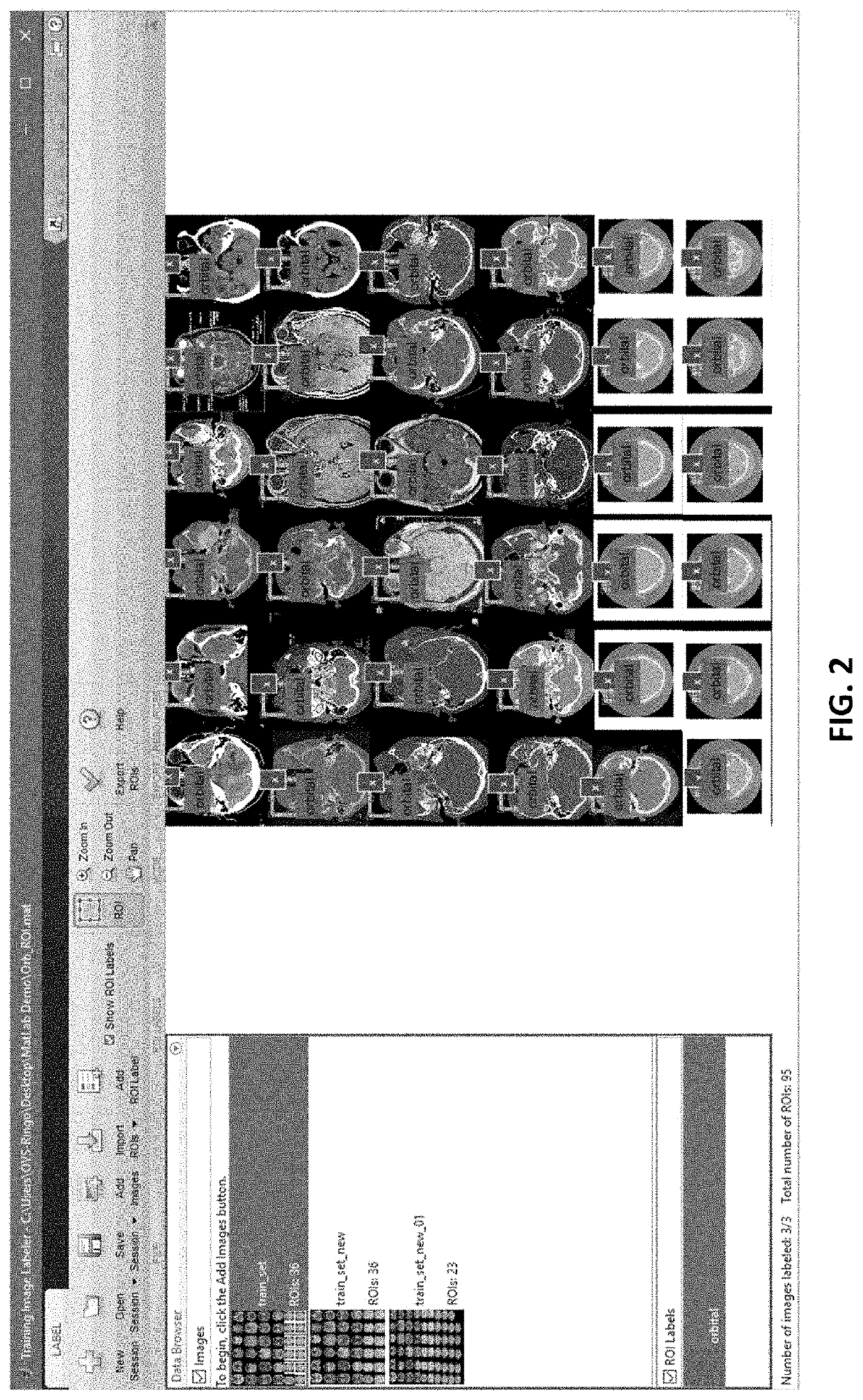 Semi-automated imaging reconstruction for orbital fracture repair