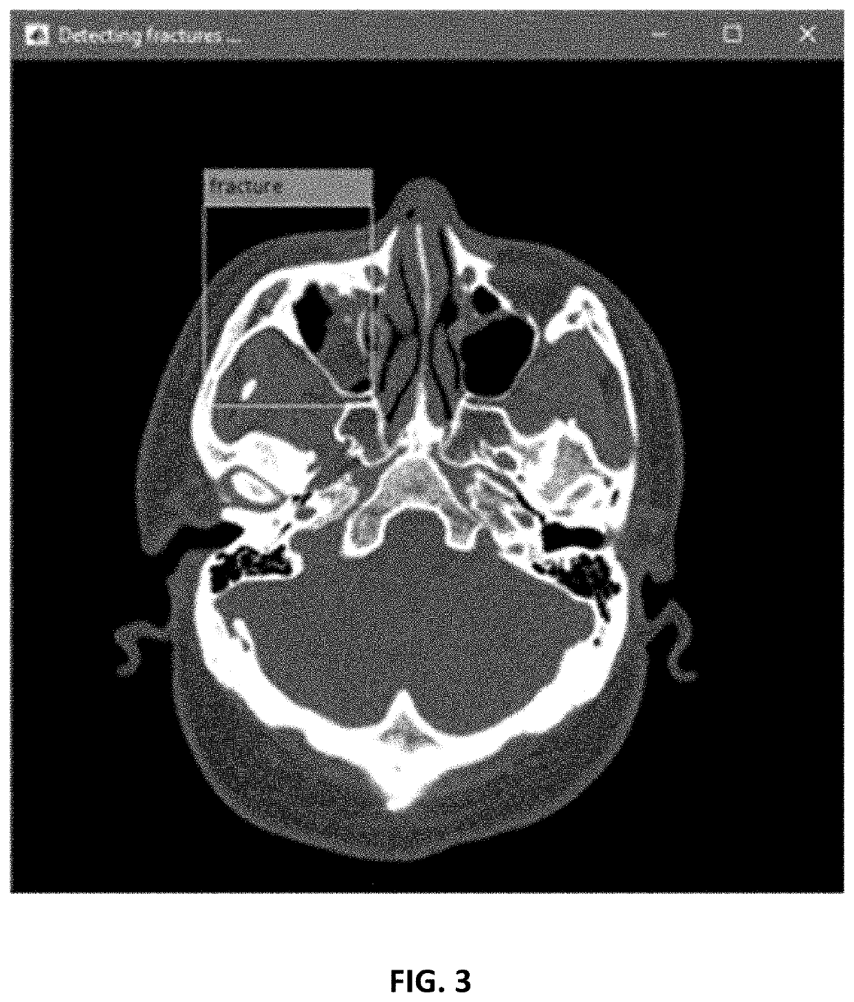 Semi-automated imaging reconstruction for orbital fracture repair