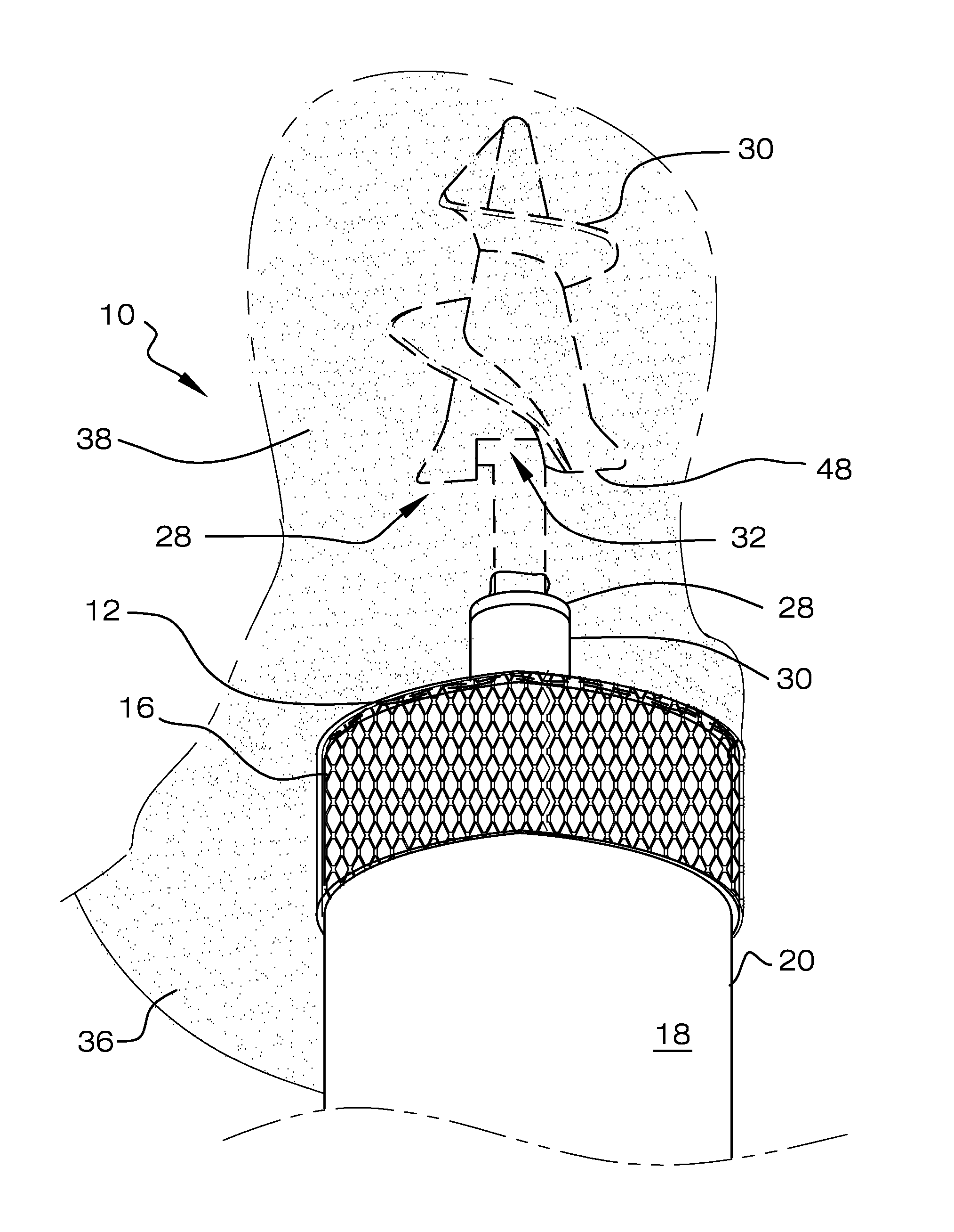 Viscerotomy closure device and method of use