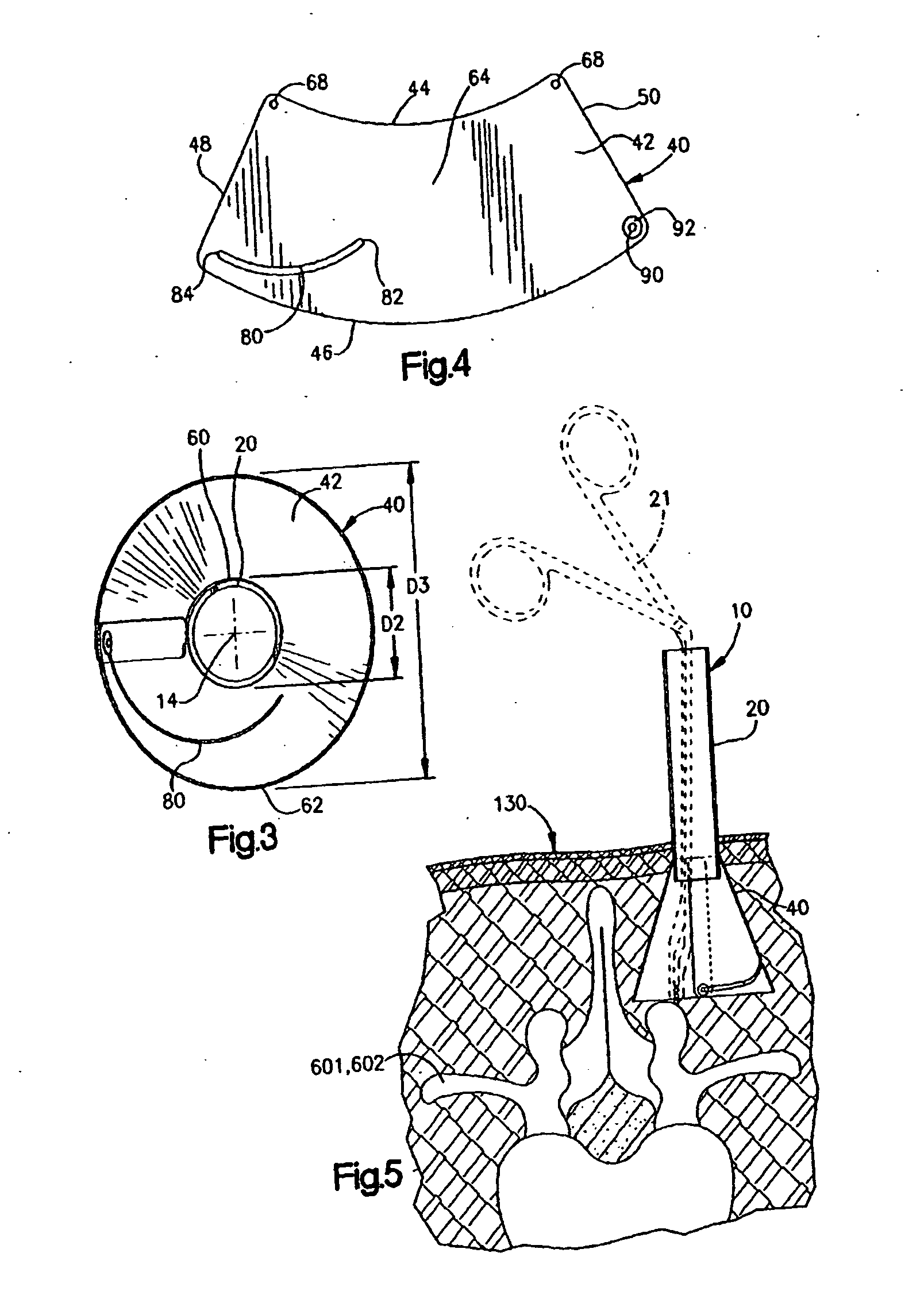 Minimally invasive access device and method