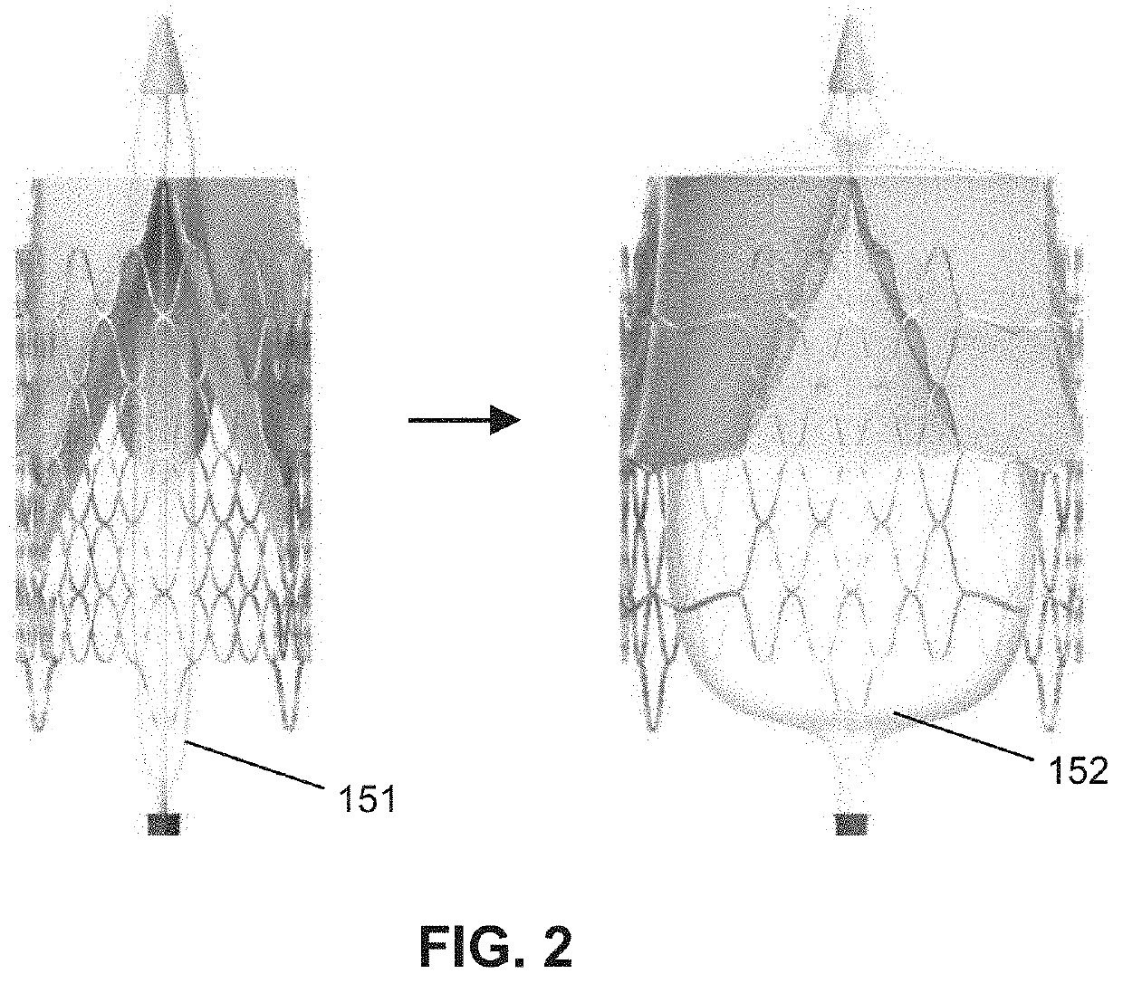 Growth-accommodating valve system