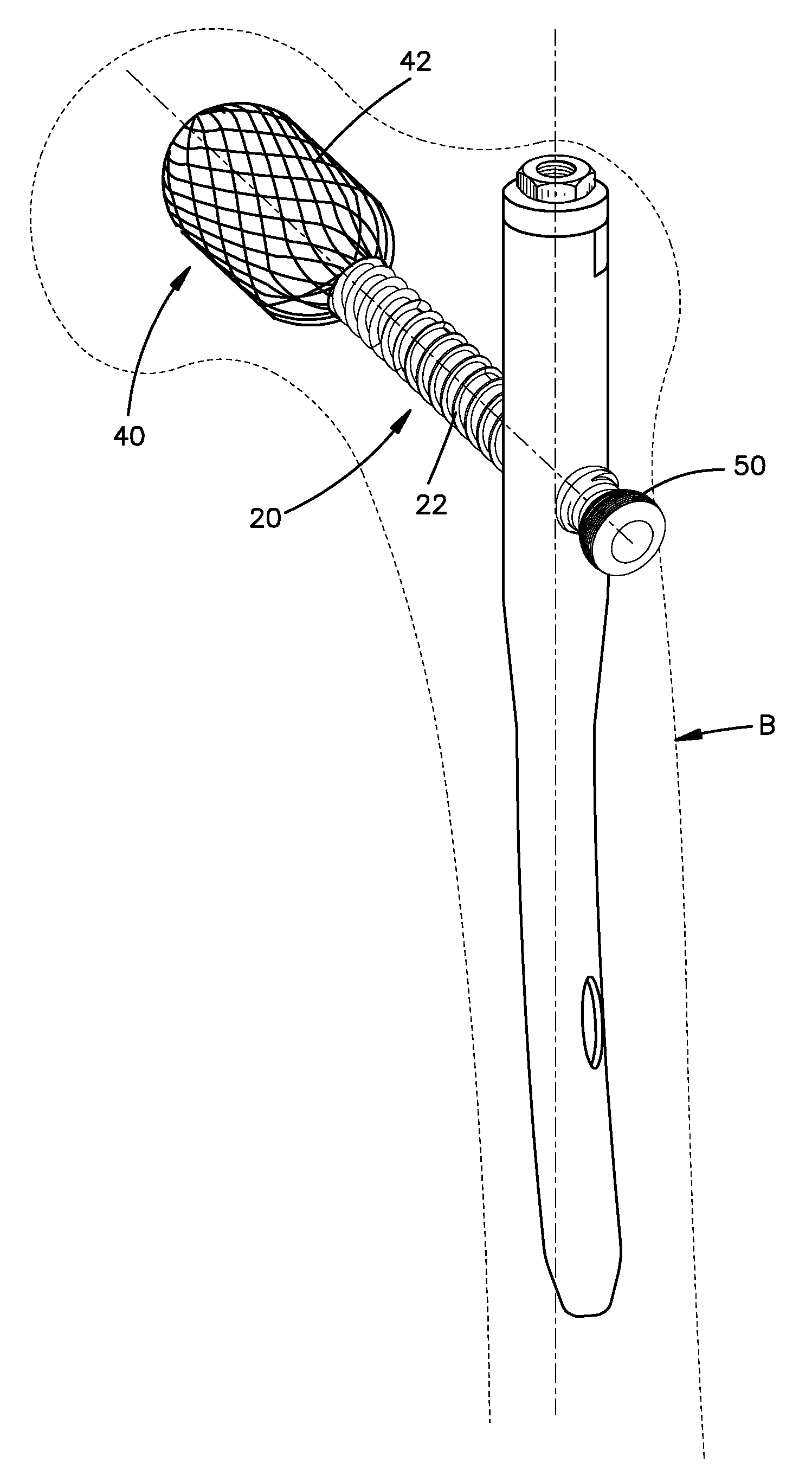 Hybrid bone fixation element and methods of using the same