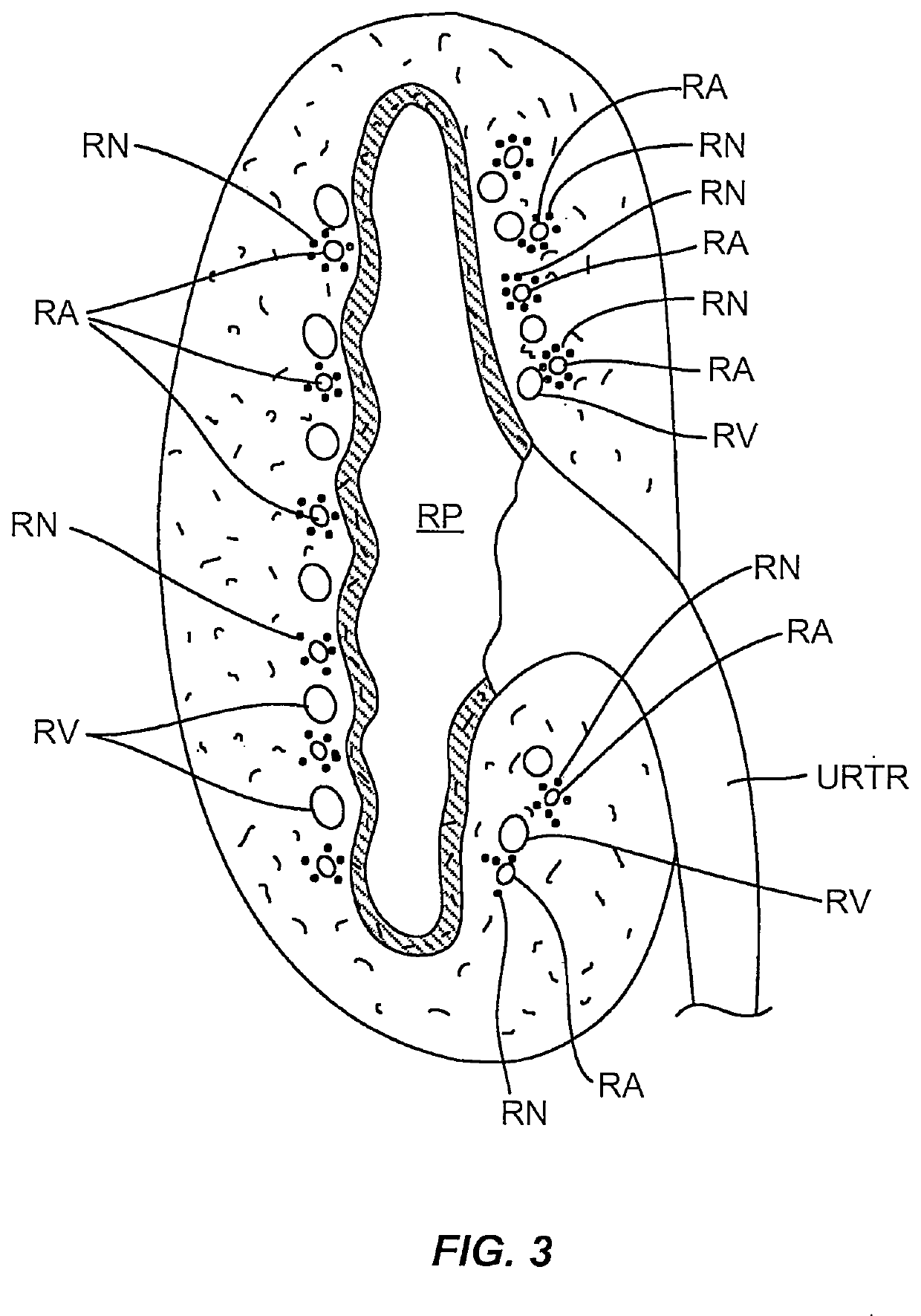 Methods and devices for treating polycystic kidney disease and its symptoms