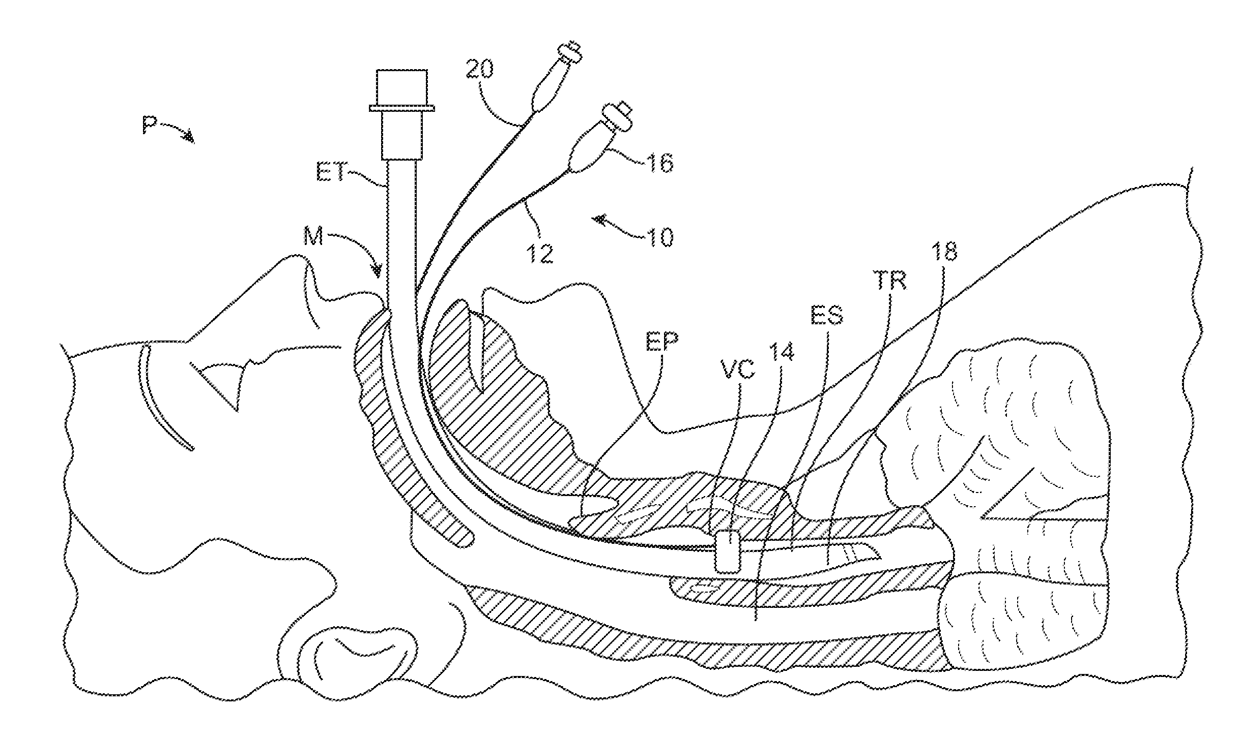 Devices and methods for preventing tracheal aspiration