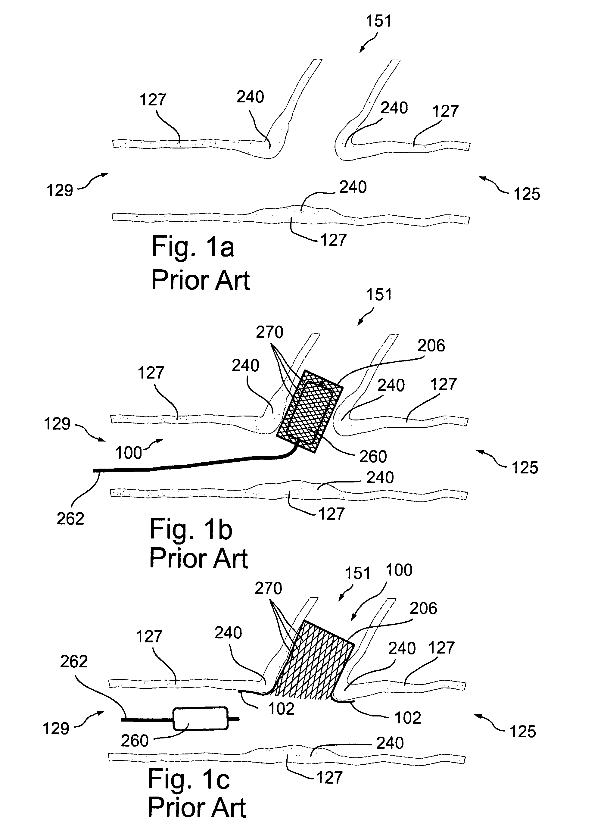 Bifurcated stent assemblies