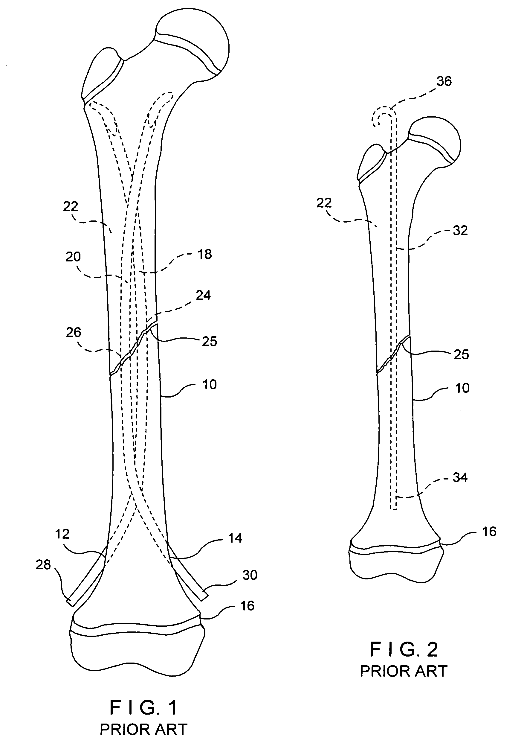 System for intramedullary rod fixation and method therefor