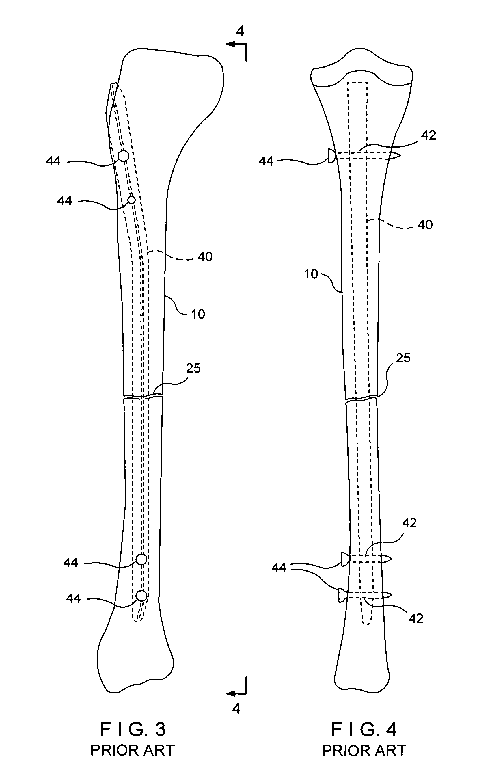 System for intramedullary rod fixation and method therefor