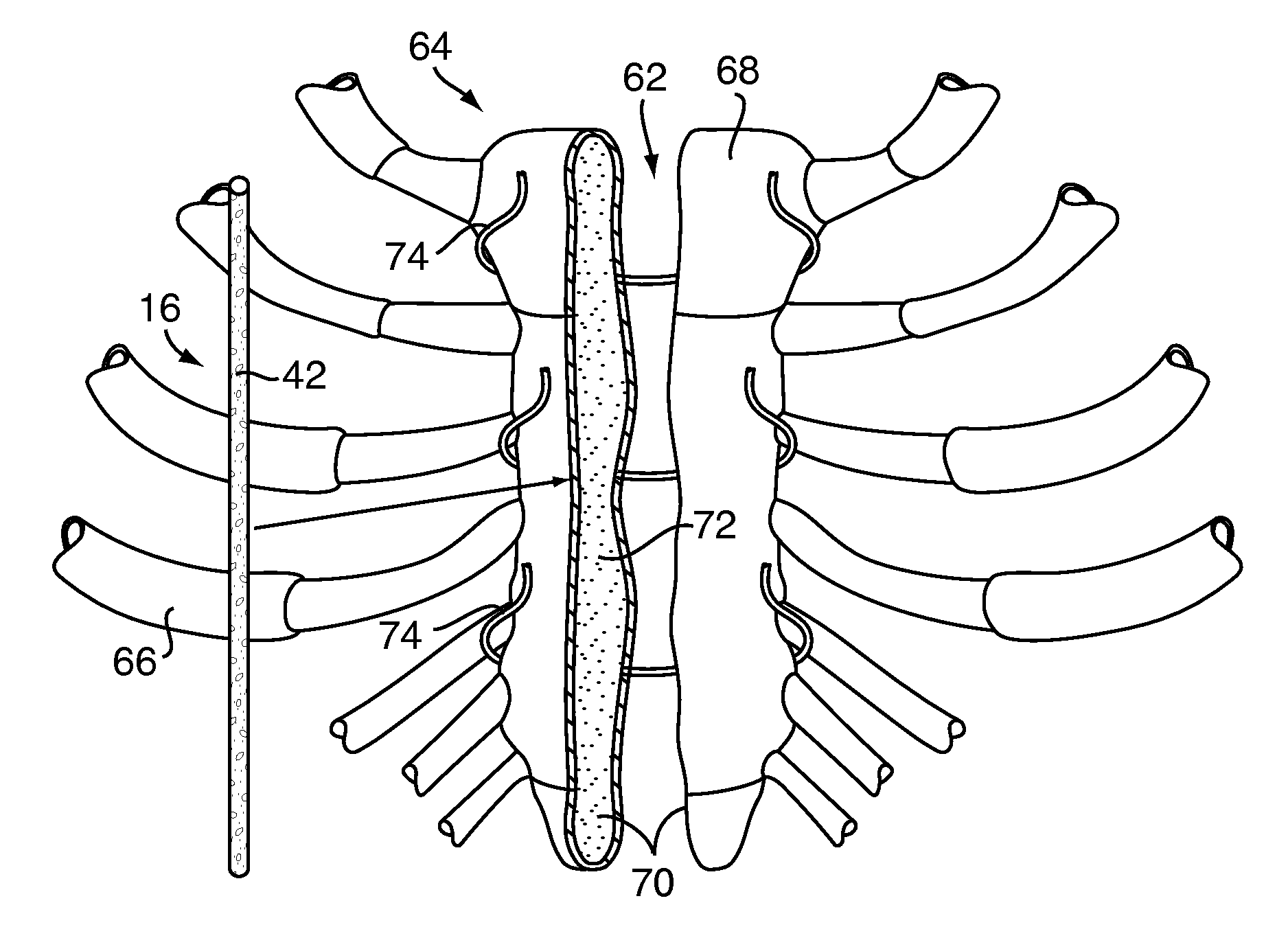 Methods and devices for repairing bone defects