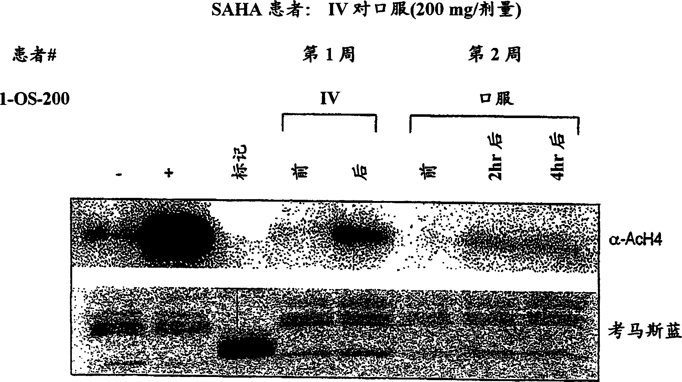 Methods of treating cancer with HDAC inhibitors