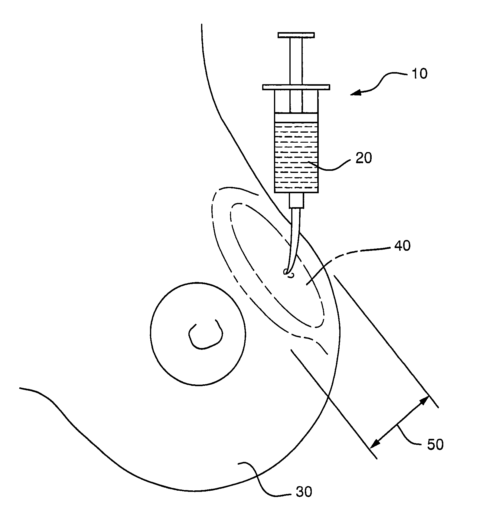 Tumescent skin spacing method