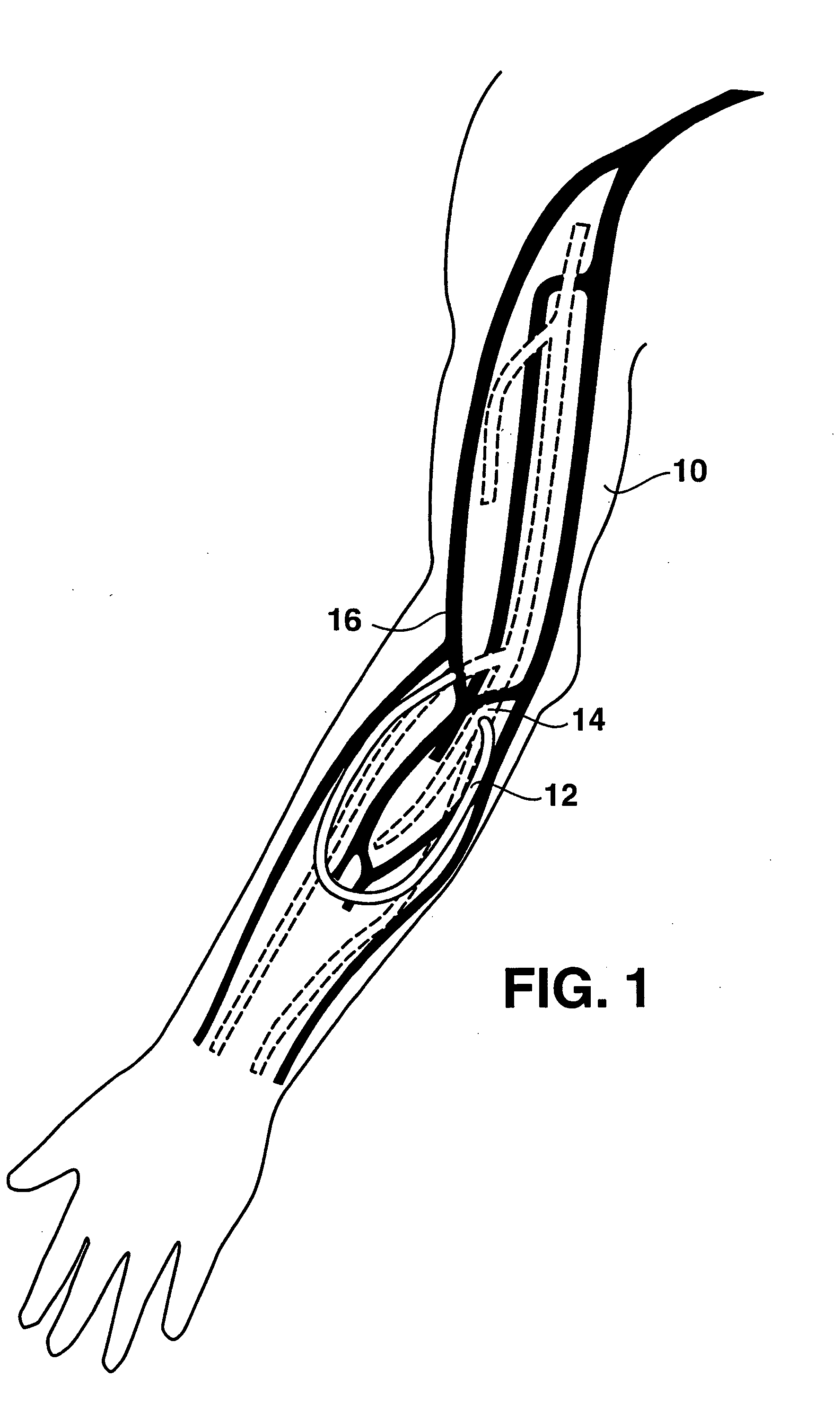 Arteriovenous access valve system and process