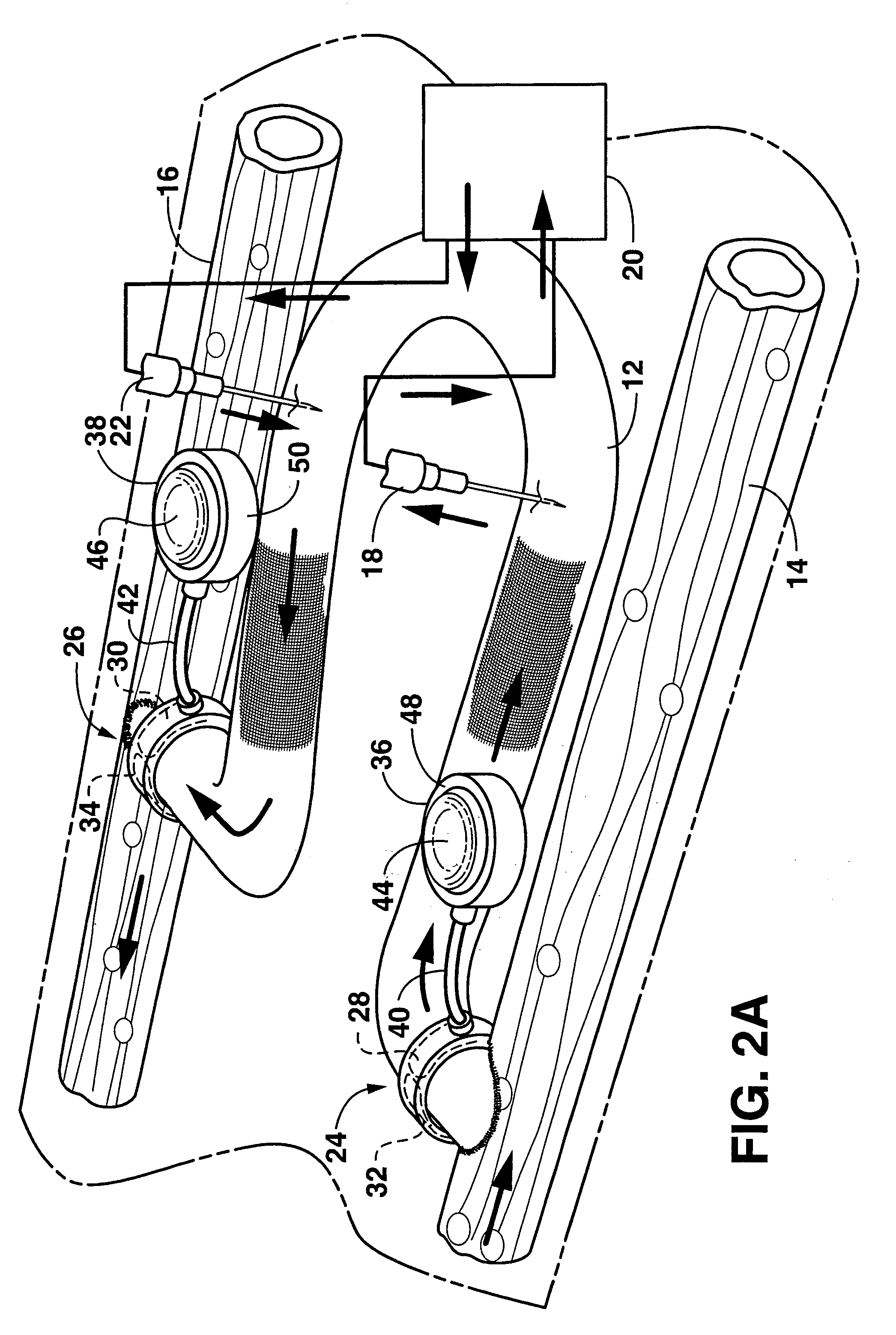 Arteriovenous access valve system and process