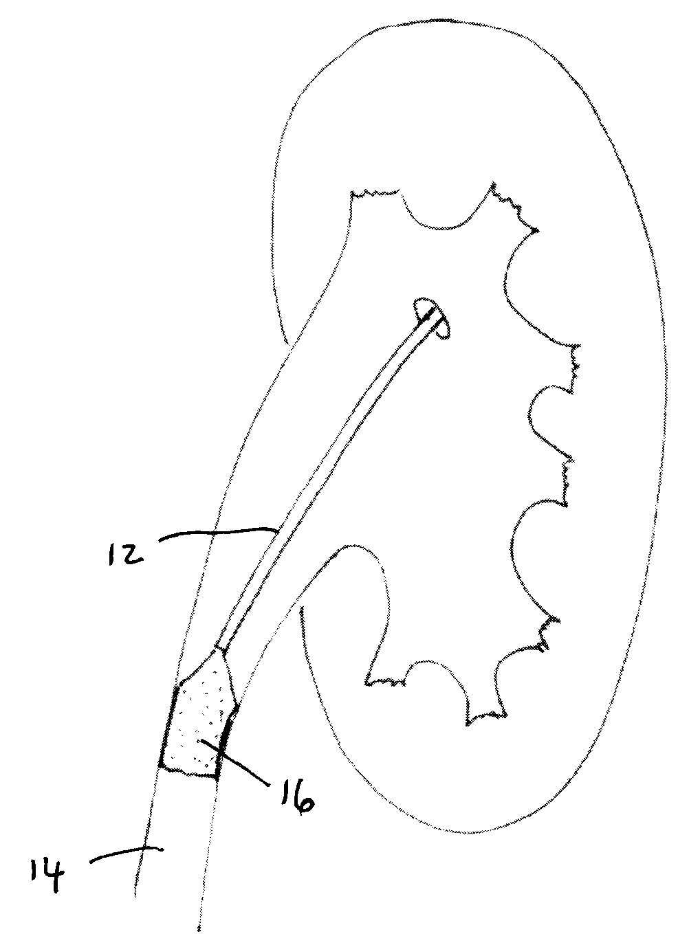 Methods and Apparatus for Temporarily Occluding Body Lumens