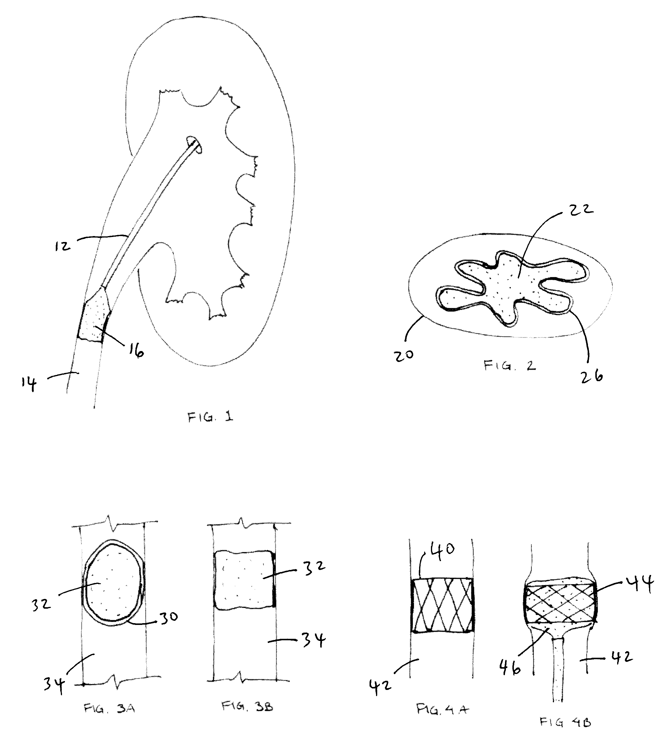 Methods and Apparatus for Temporarily Occluding Body Lumens