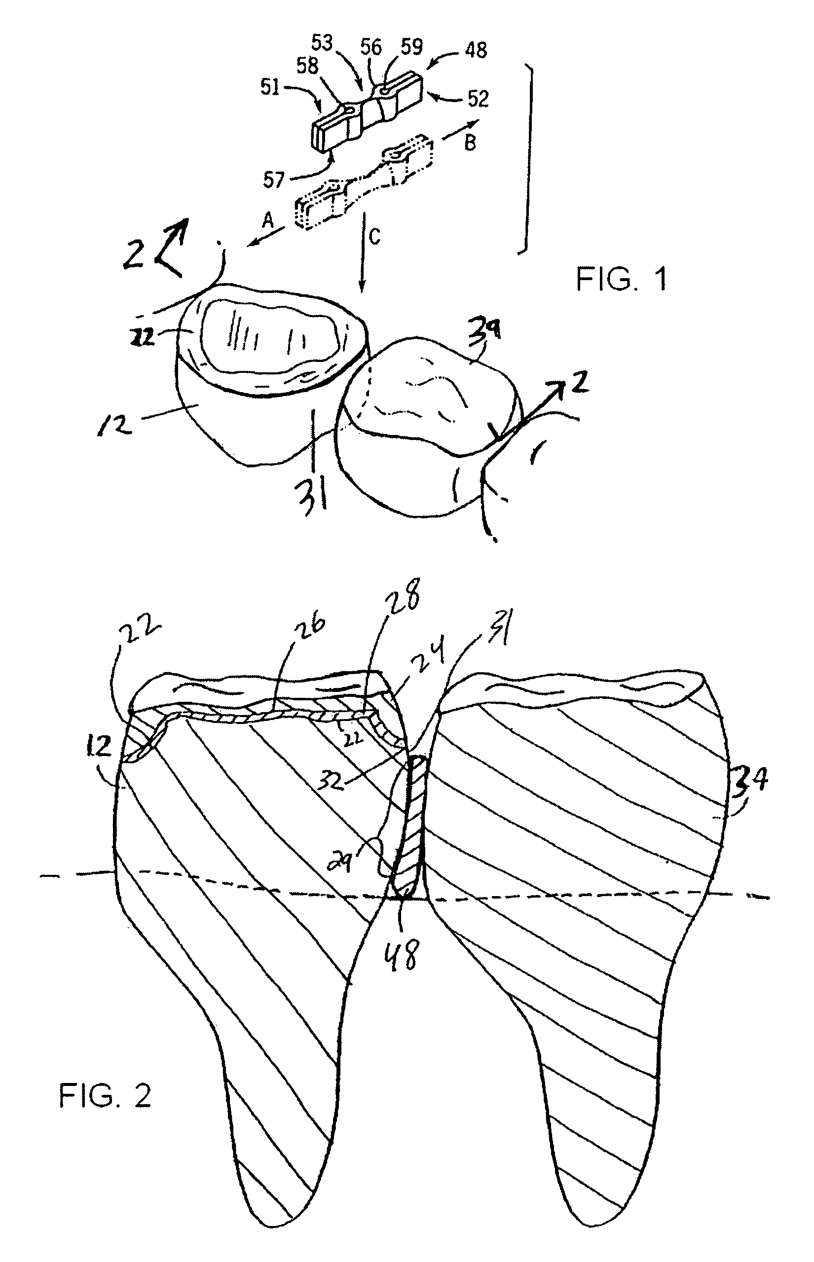 Methods and devices for fixed dental restoration