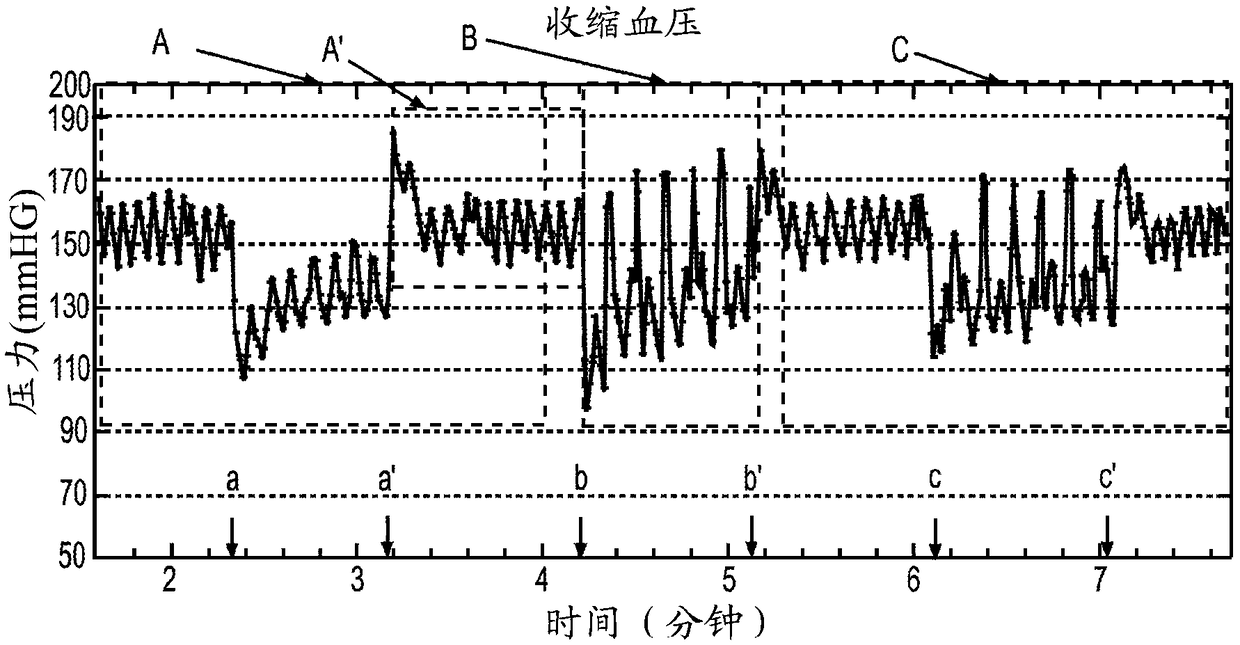 Methods and Systems for Lowering Blood Pressure Through Reduction of Ventricle Filling