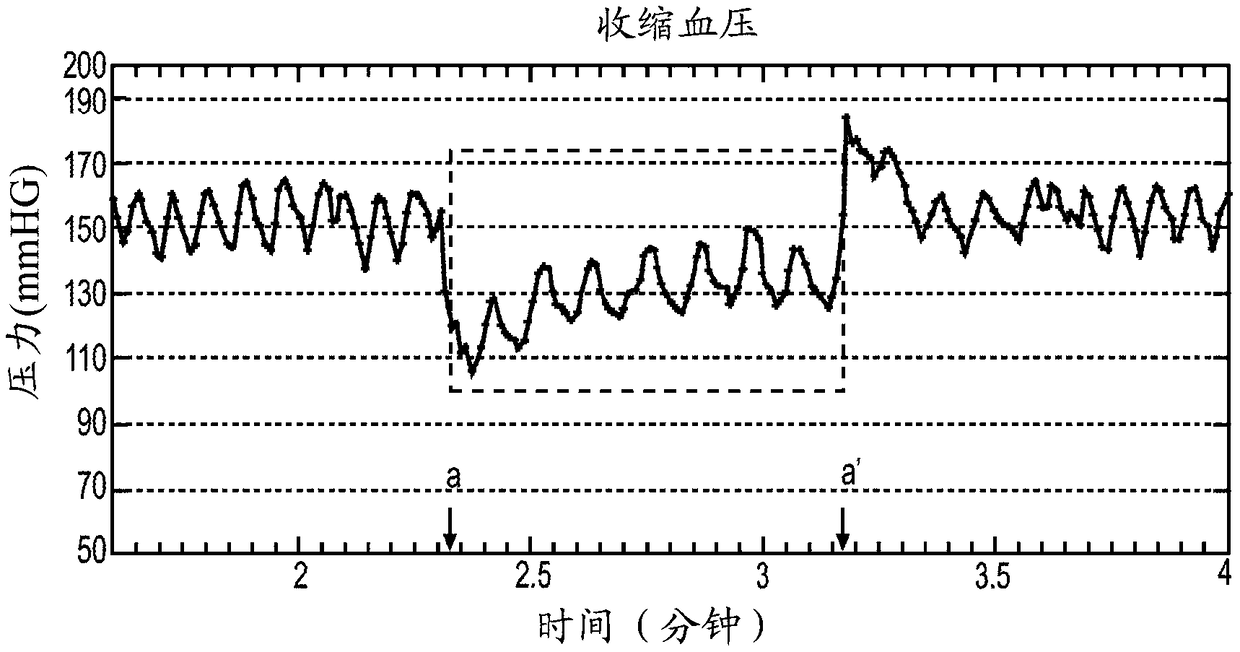 Methods and Systems for Lowering Blood Pressure Through Reduction of Ventricle Filling