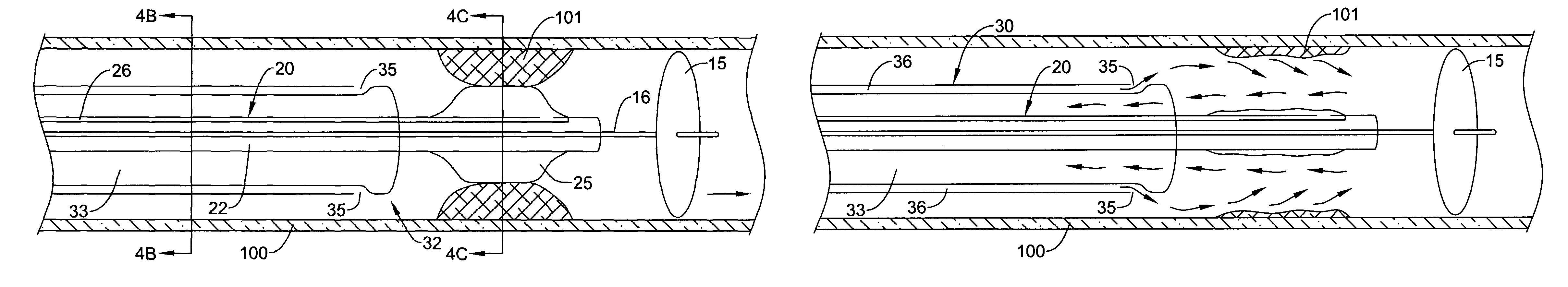 Endoluminal occlusion-irrigation catheter with aspiration capabilities and methods of use