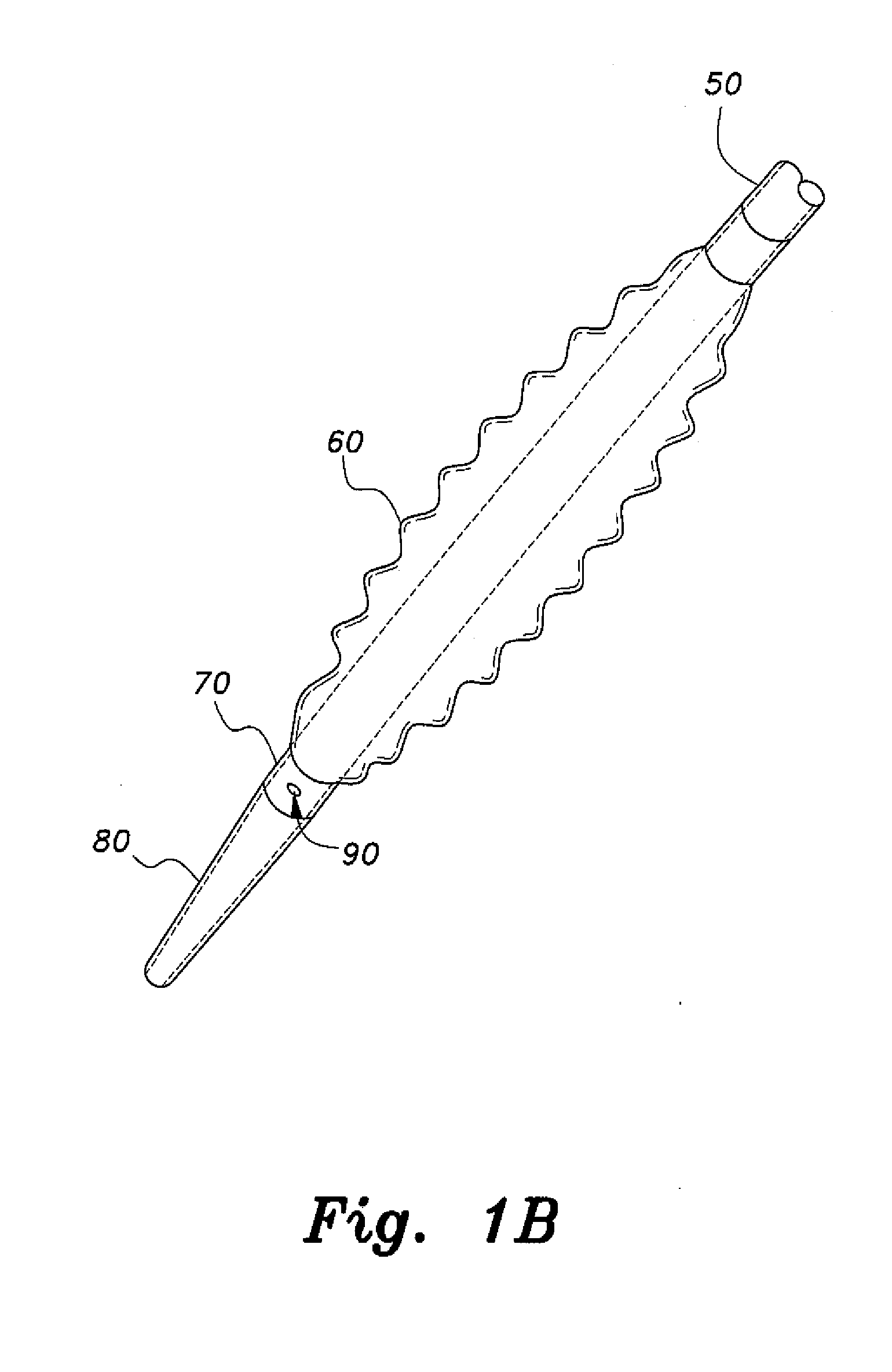 Apparatus for closure of atrial septal defects