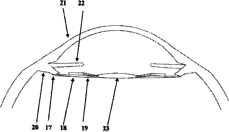 Haptic devices for intraocular lenses