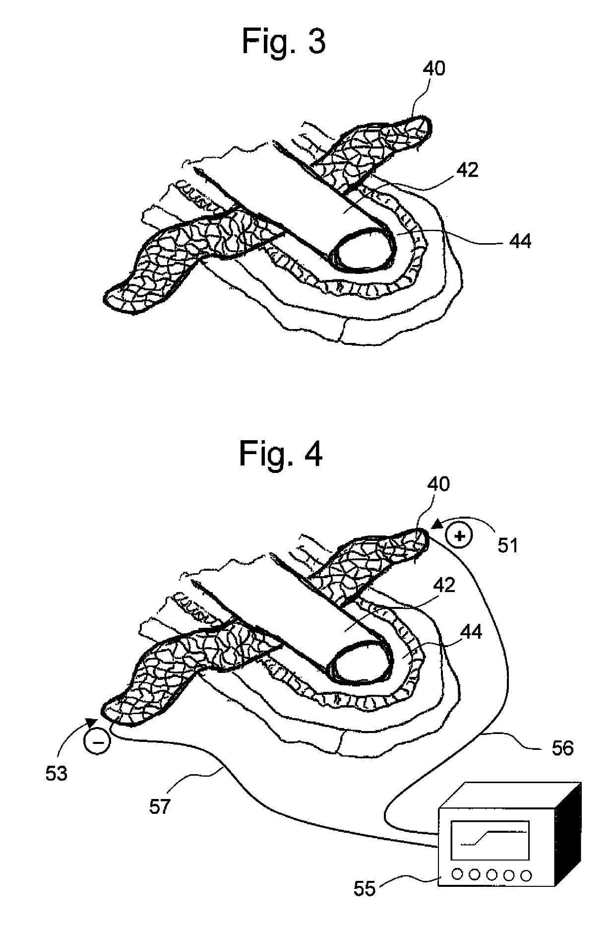 Conductive and degradable implant for pelvic tissue treatment